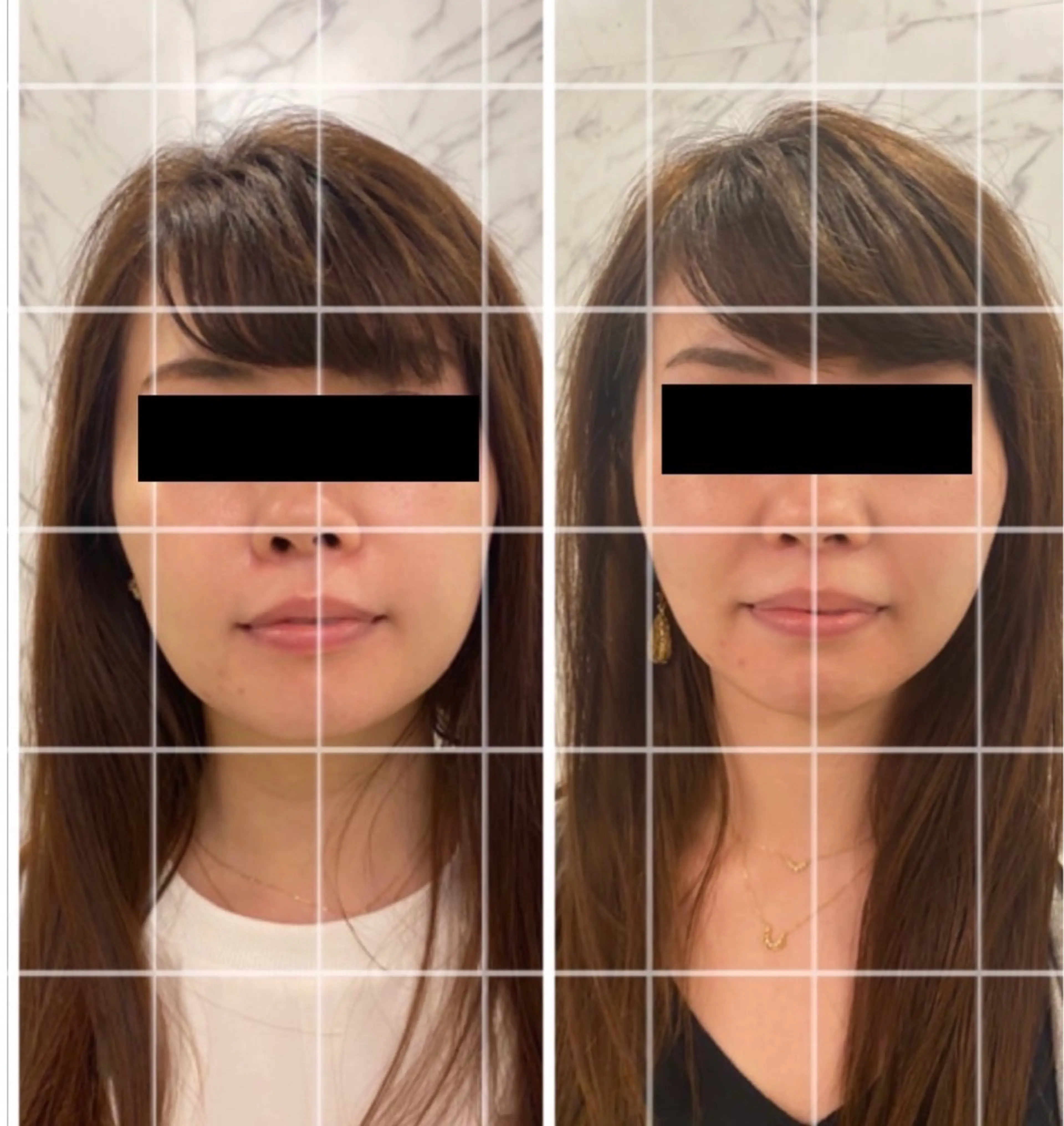 【プレオープン記念】小顔リフトアップ効果⤴️最新NR機器を使用❣️の写真