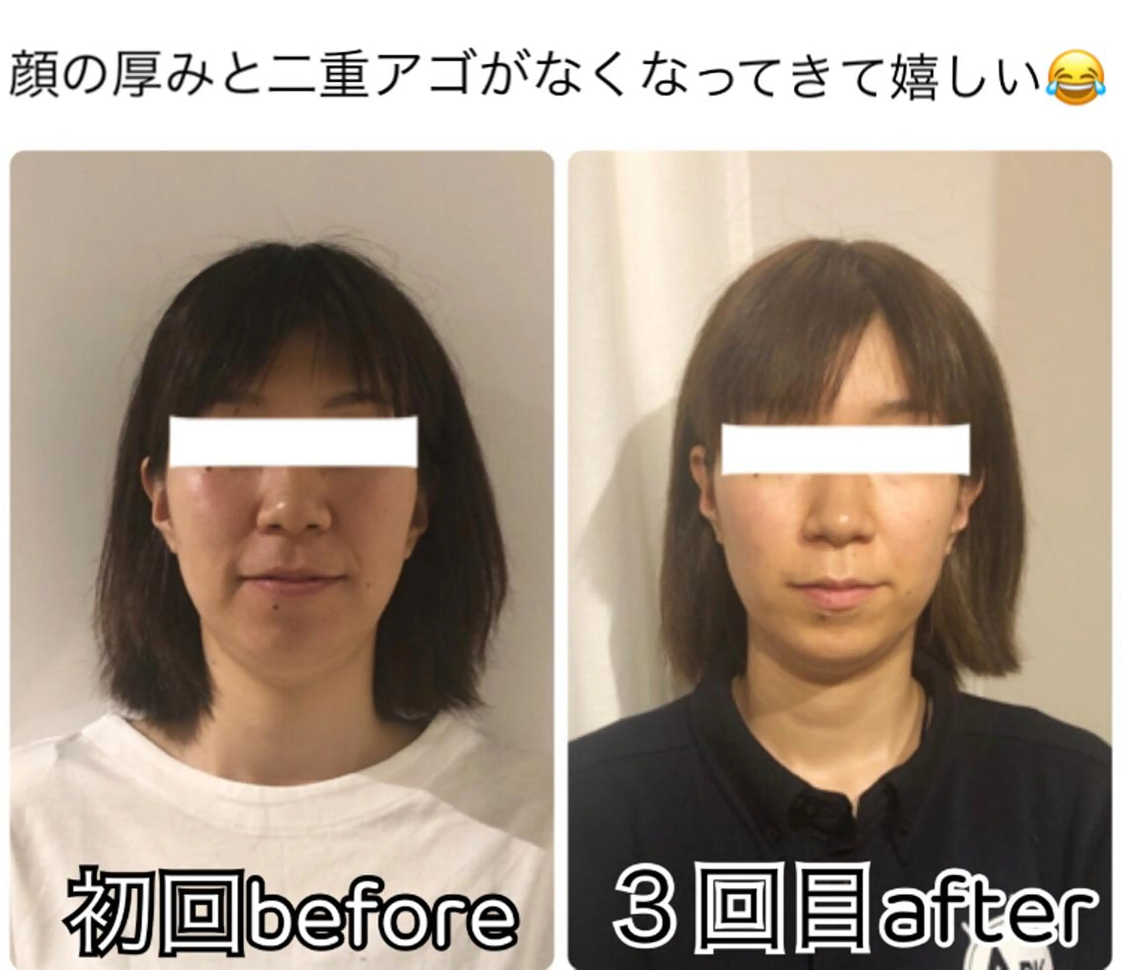 むくみ取りフェイスラインスッキリ　フルコース🔱ご新規様限定の写真
