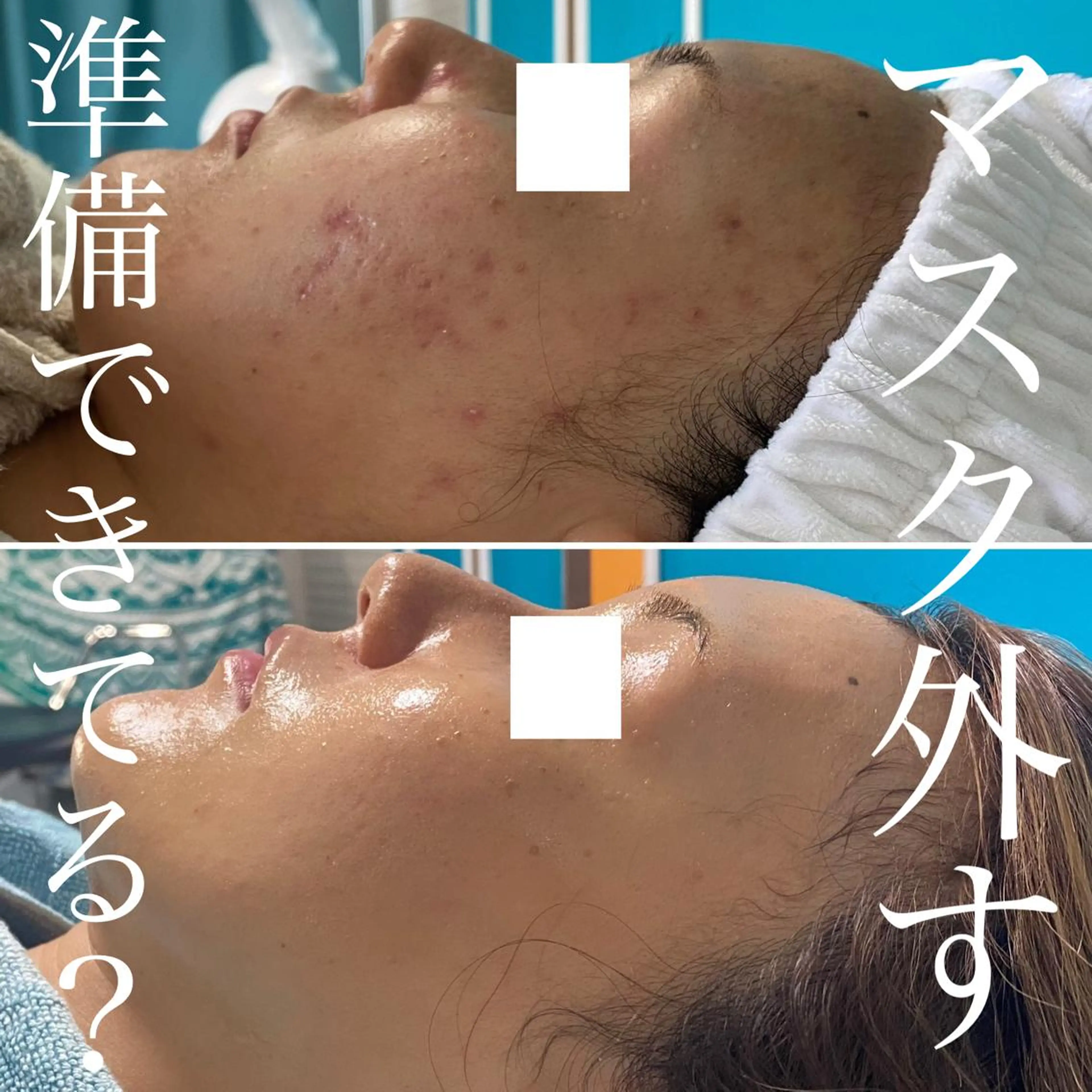 【ミニモ学割】ダウンタイムなし‼️ニキビでお困りの方にもおすすめ💕バクテリウムピール４回コース✨メンズOK🙆‍♀️の写真
