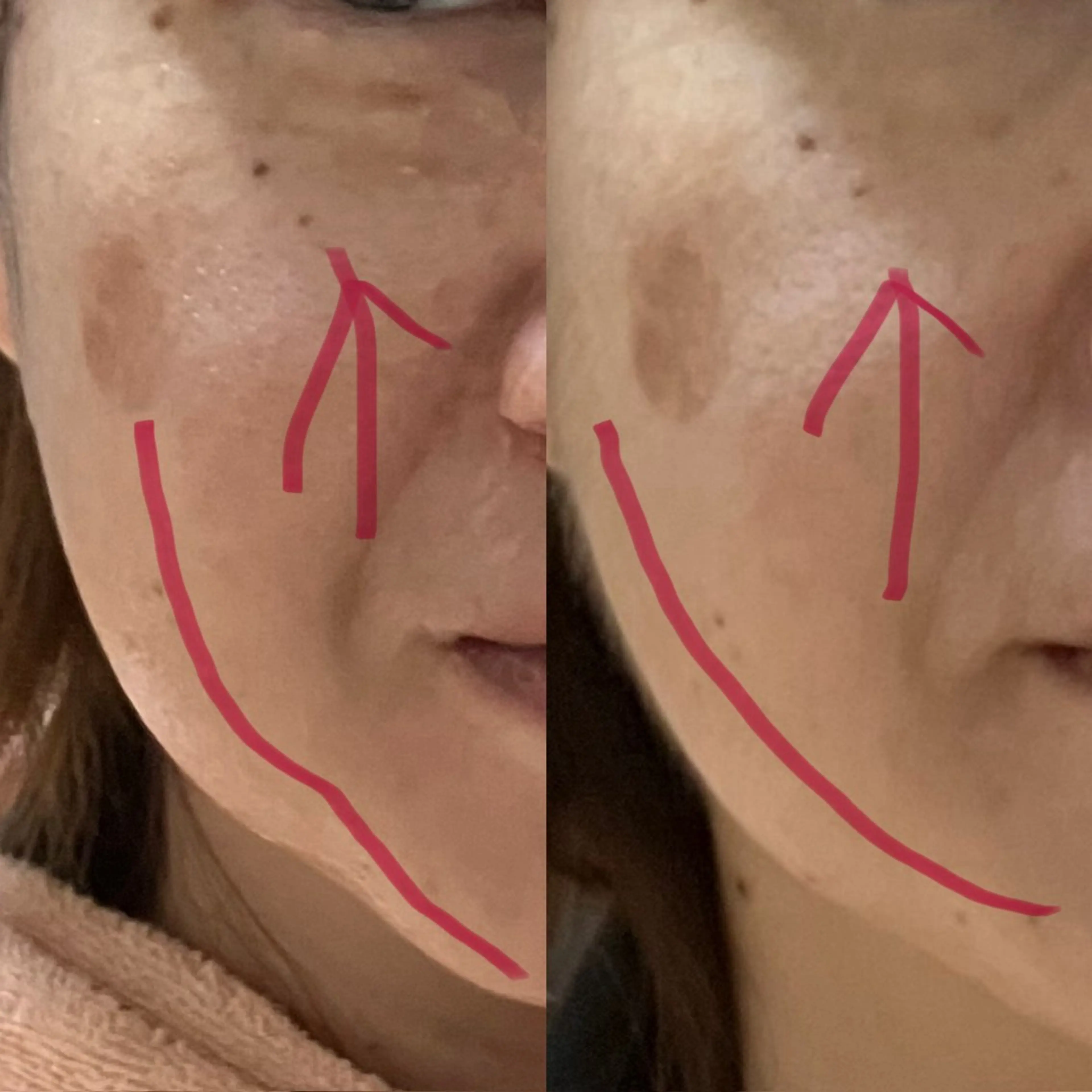 小顔エステBefore after 撮影モデルの写真
