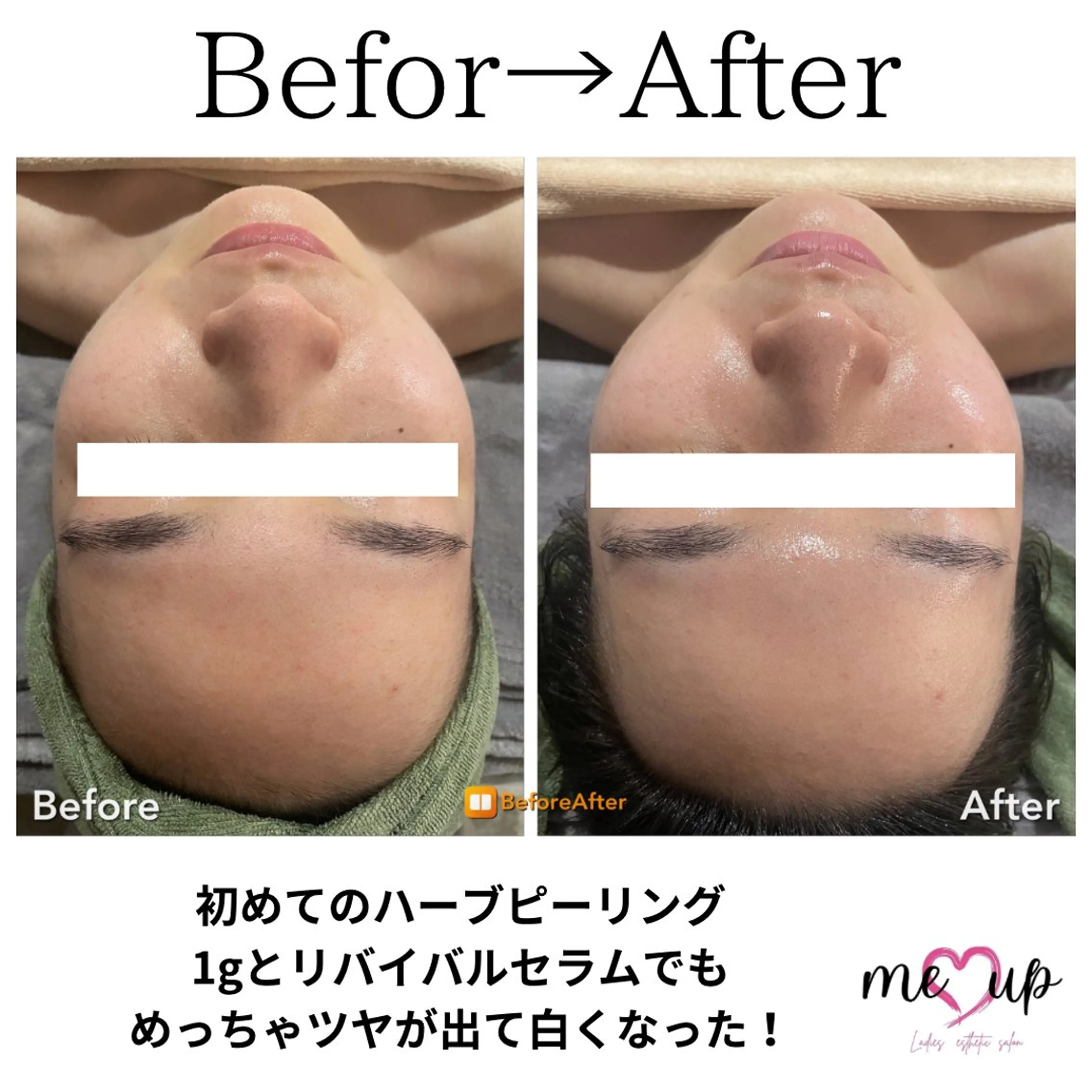 エステ Meupニキビ専門店 背中/ハーブ/ララのその他イメージ