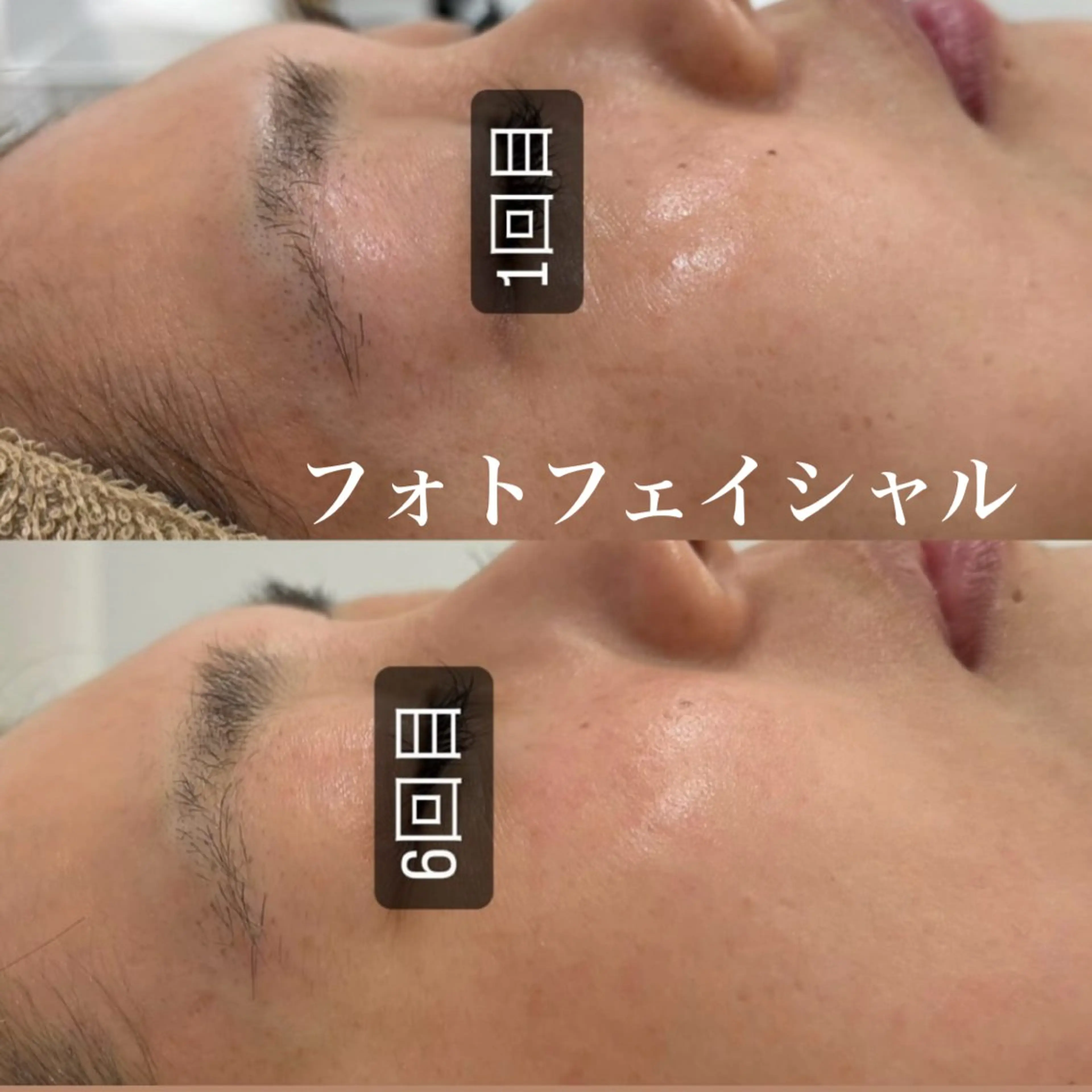 【シミ、色素沈着にはコレ☝🏻】光エステの写真