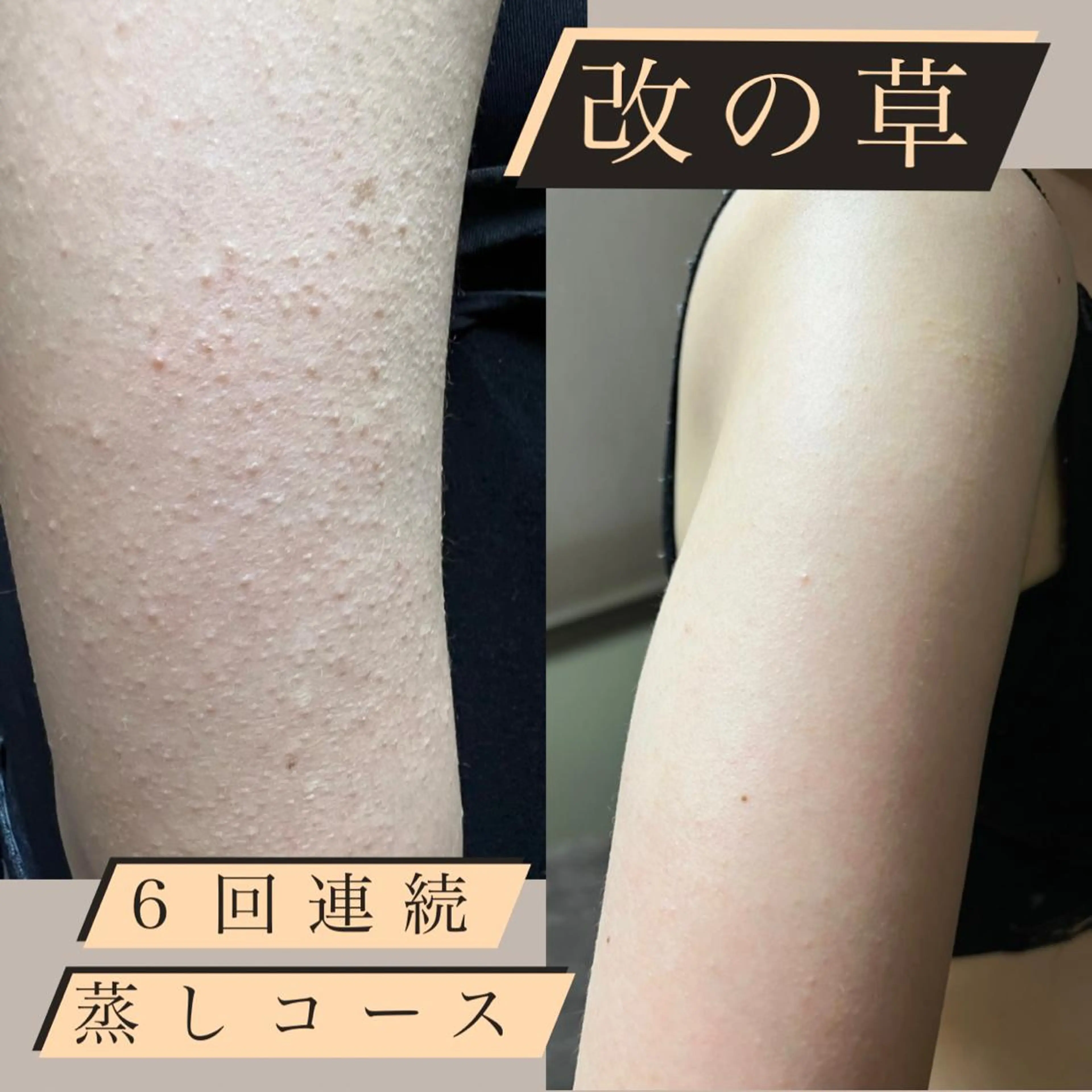 若よもぎ蒸し 】 改の草連続蒸し6回コース 『 毛孔性苔癬