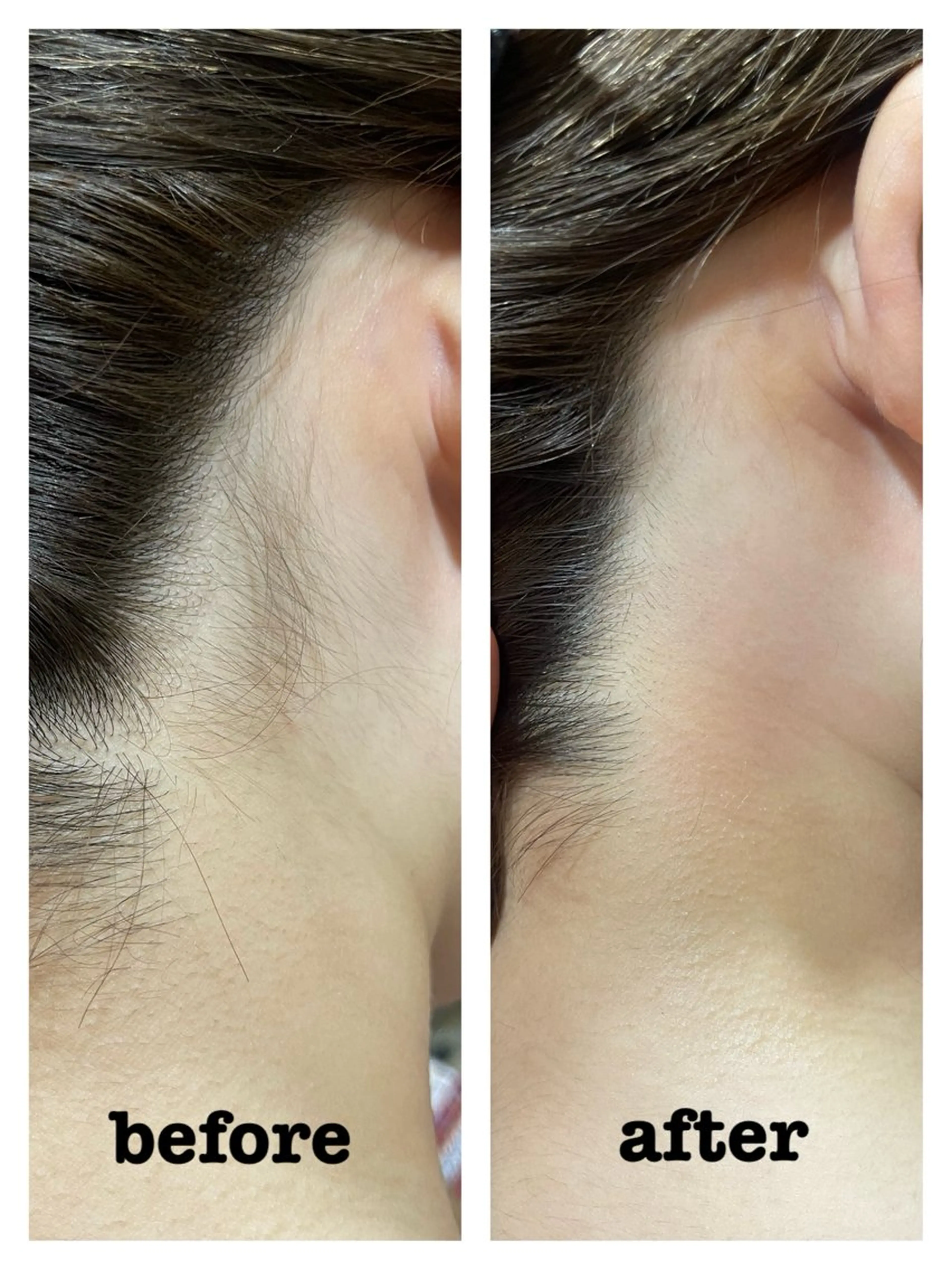 【脱毛U24大人気部位👇】遂に導入‼️🌹綺麗なうなじへ👩🦰襟足脱毛🌹※詳細を必ずご確認ください。の写真