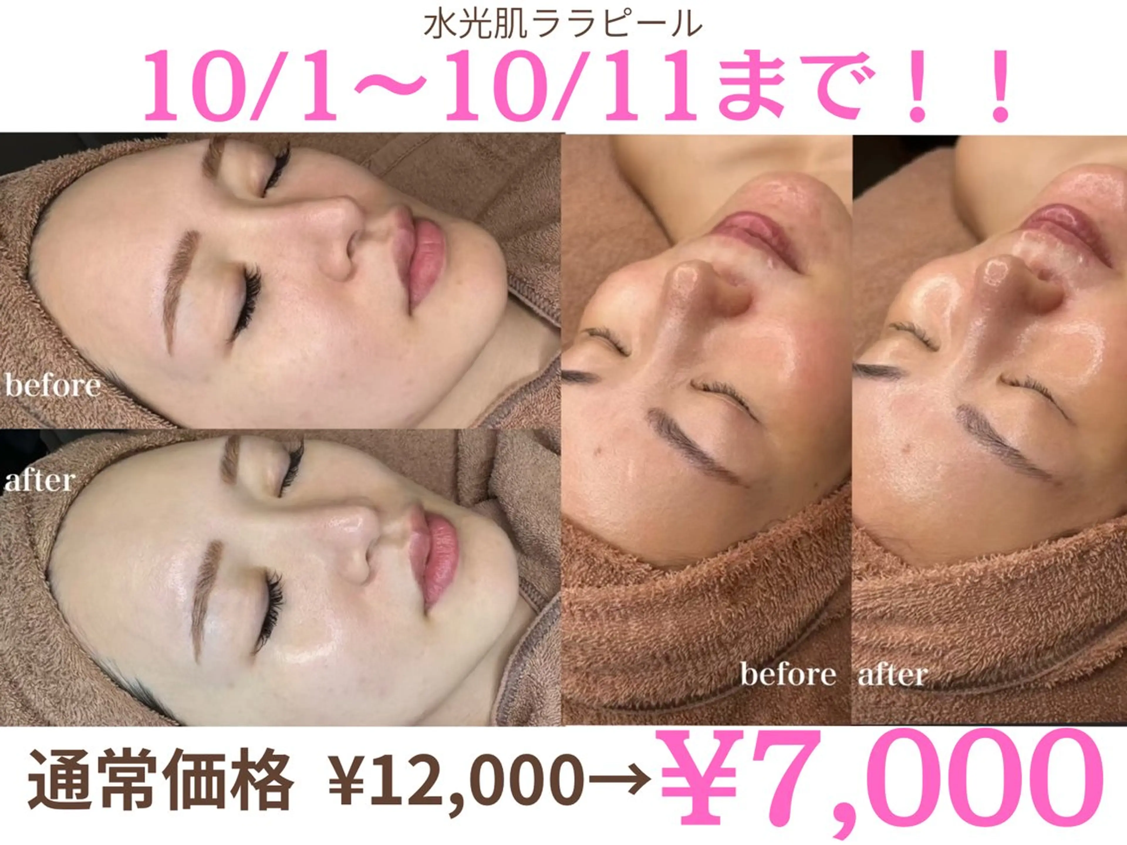 【10/1～10/11限定】✨毛穴吸引×ララピール×デコルテマッサージ×光美顔トータル美肌コース✨の写真