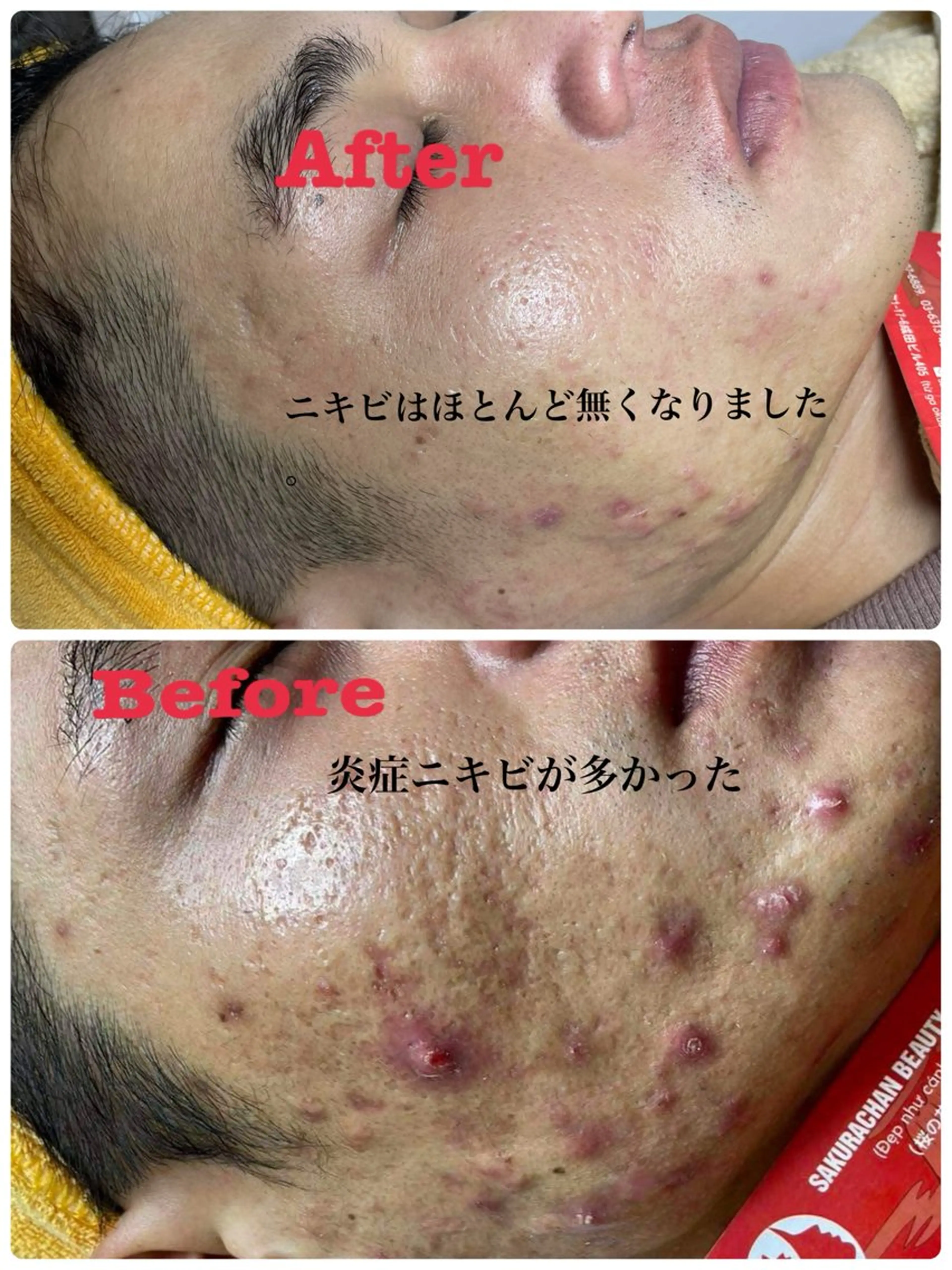 エステ ニキビ、痩身、脱毛、 サクラチャンスパのエステ・リラクイメージ