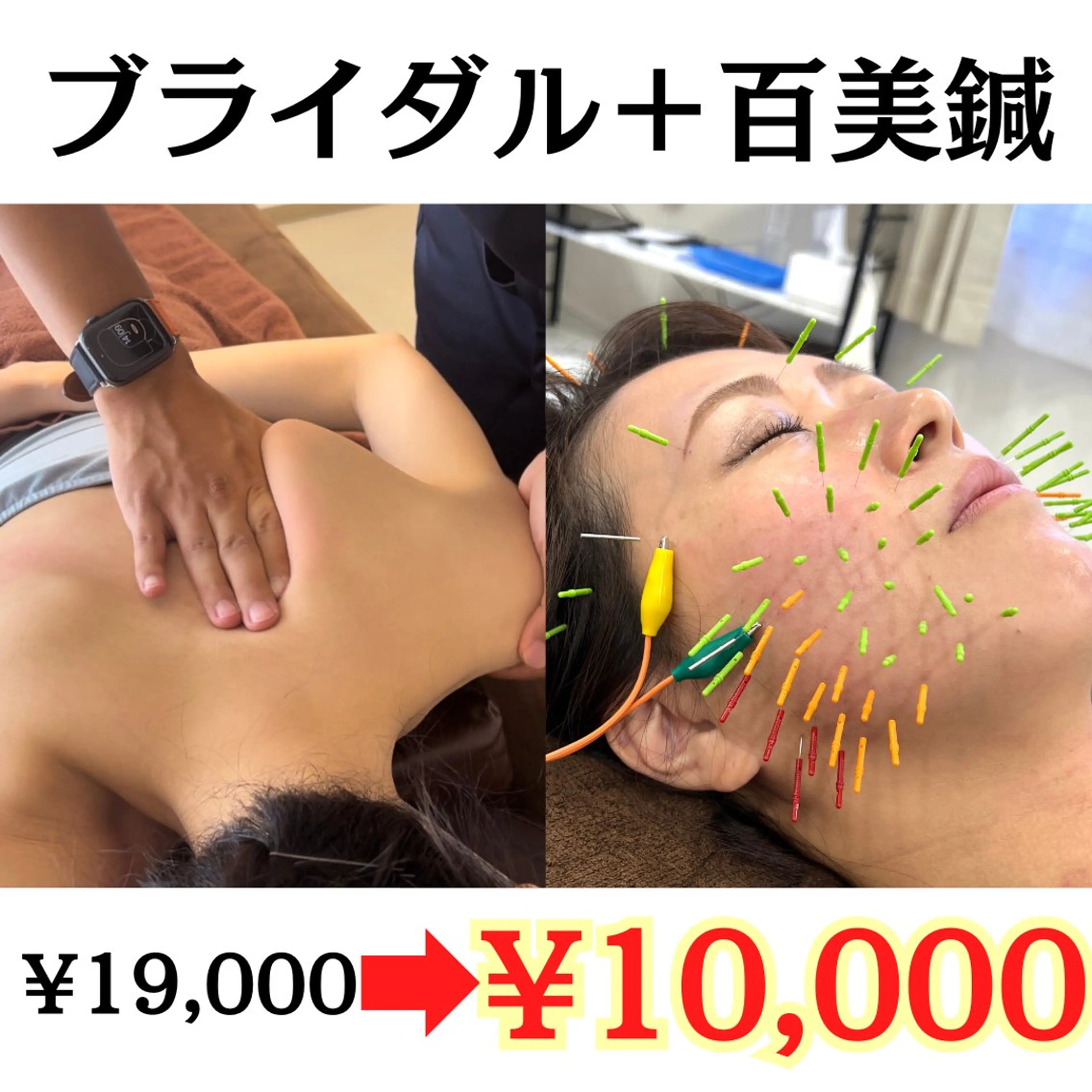 【Summerクーポン】ブライダル整体×百美鍼(100分)（美容鍼100本/小顔/肩甲骨はがし/姿勢矯正）の写真