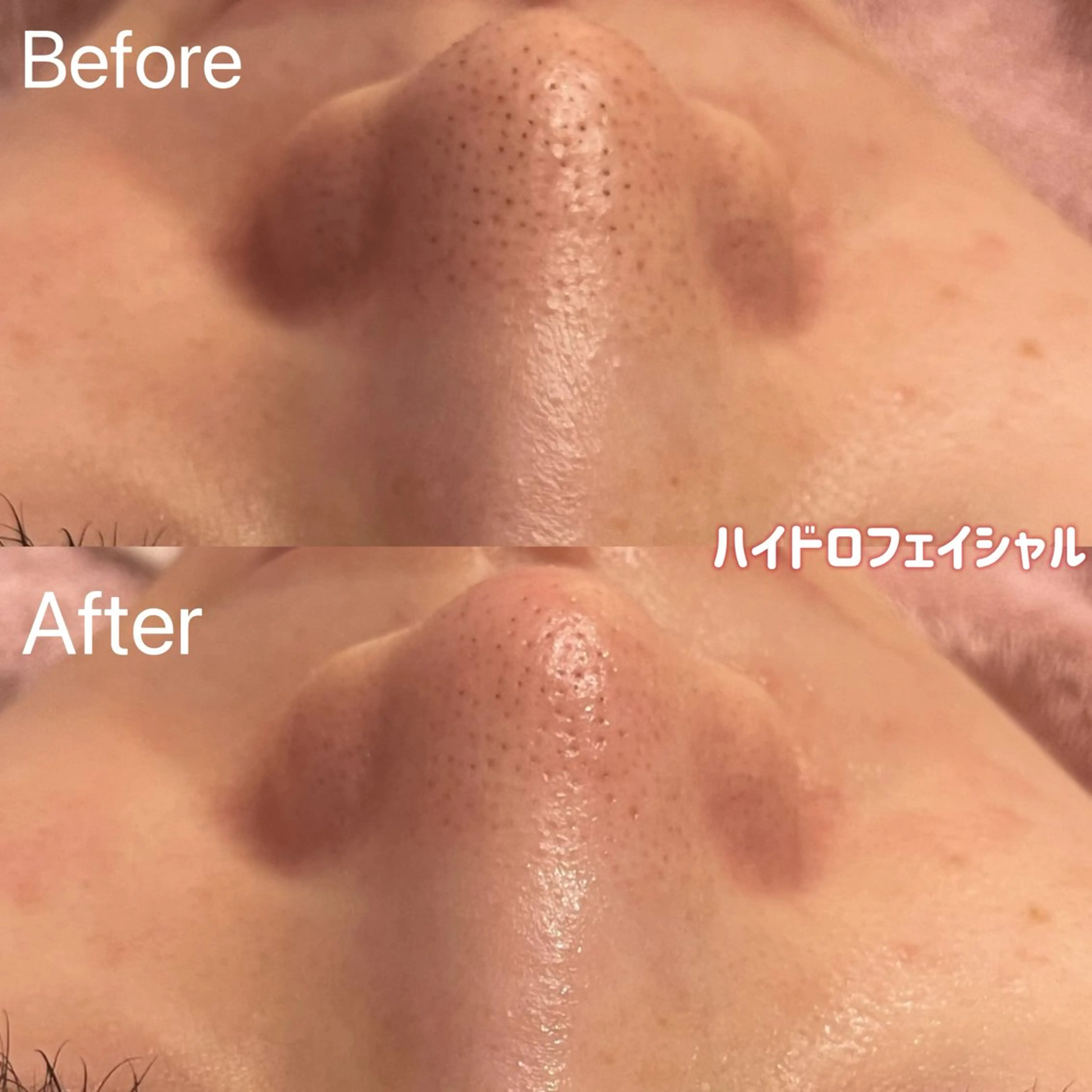 【鼻のみ】毛穴詰まり・黒ずみざらつき徹底ケア☆毛穴洗浄の写真