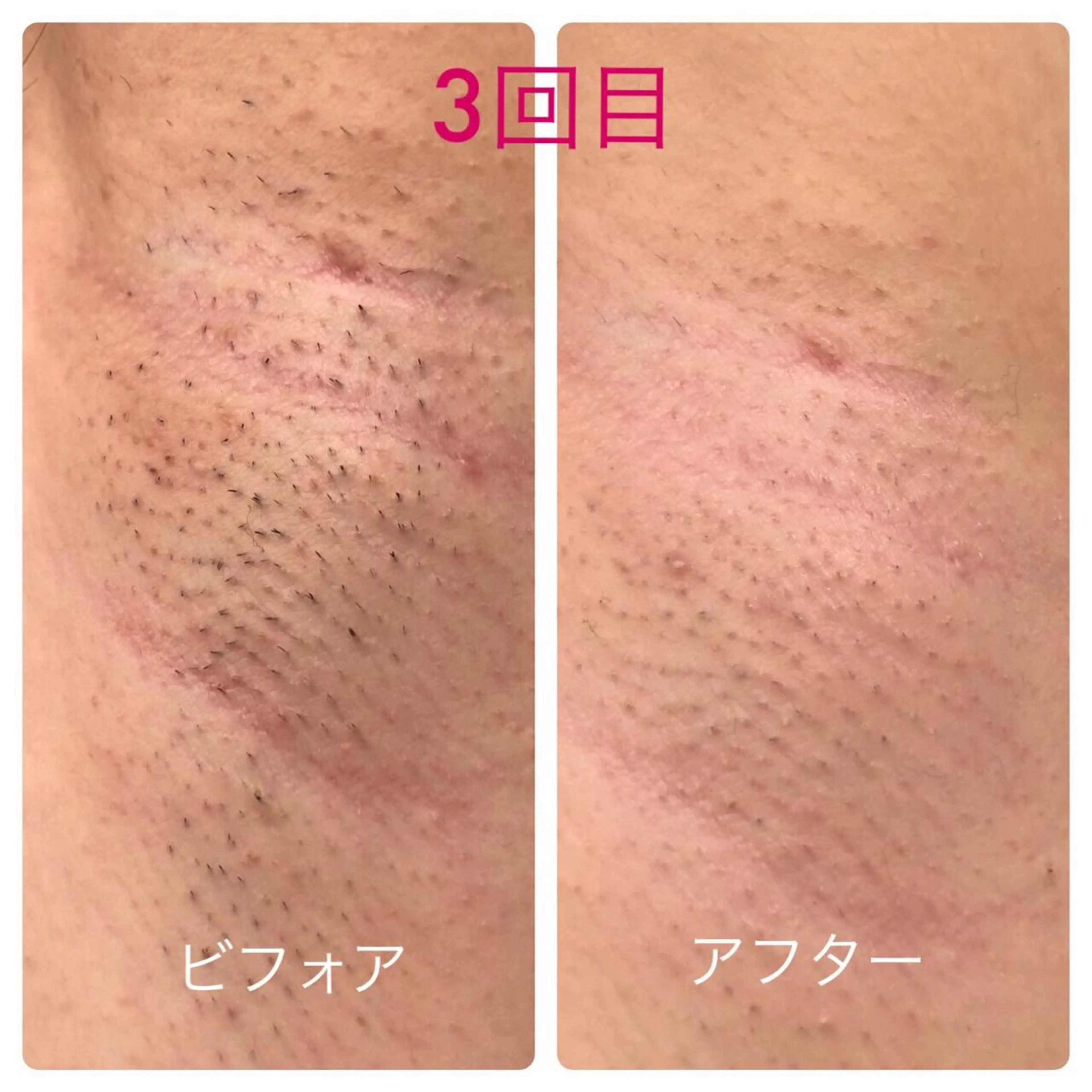 毛穴＆ニキビ改善／ ワックス脱毛×光脱毛のエステ・リラクイメージ