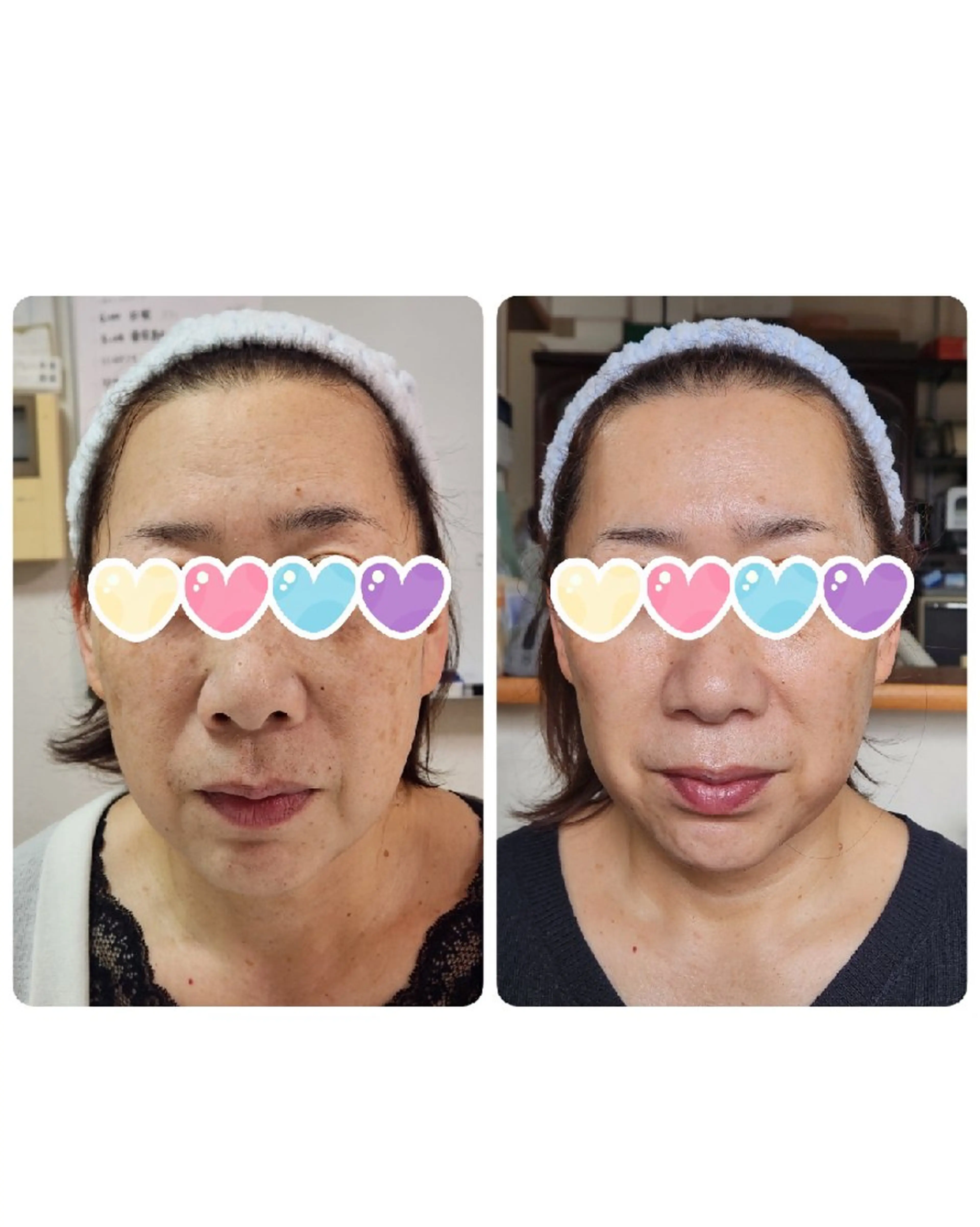 【40代の本気の肌質改善】くすみ・乾燥・シワ・たるみ改善✨美肌体感モニターの写真