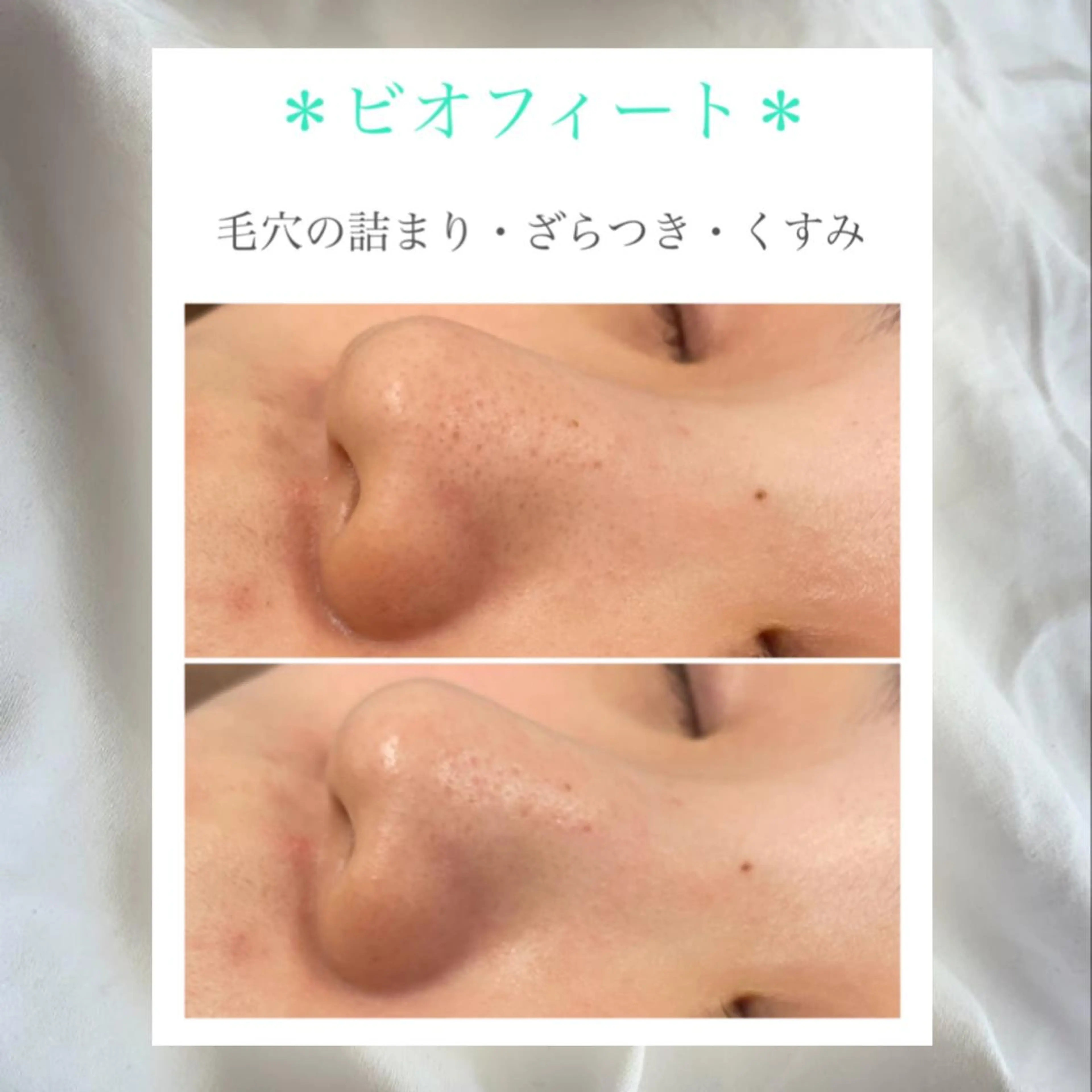 今人気のハーブピーリング🌿剥離なし✨クリスティーナ【ビオフィート】💁‍♀️💕の写真