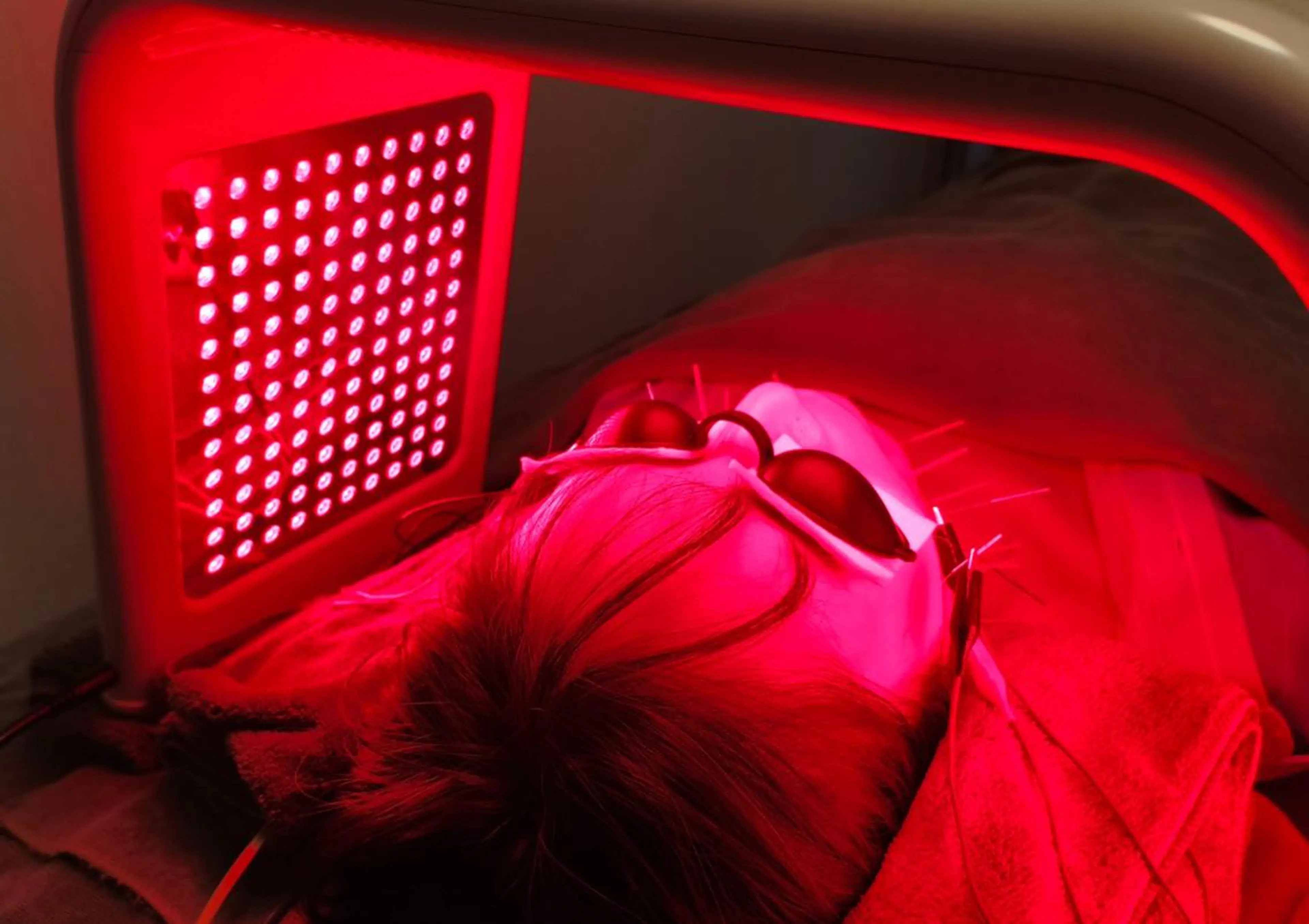 minimo限定メニュー《モニター募集》小顔リフト美容鍼+LED 4回コース ¥60,800 → ¥16,000の写真
