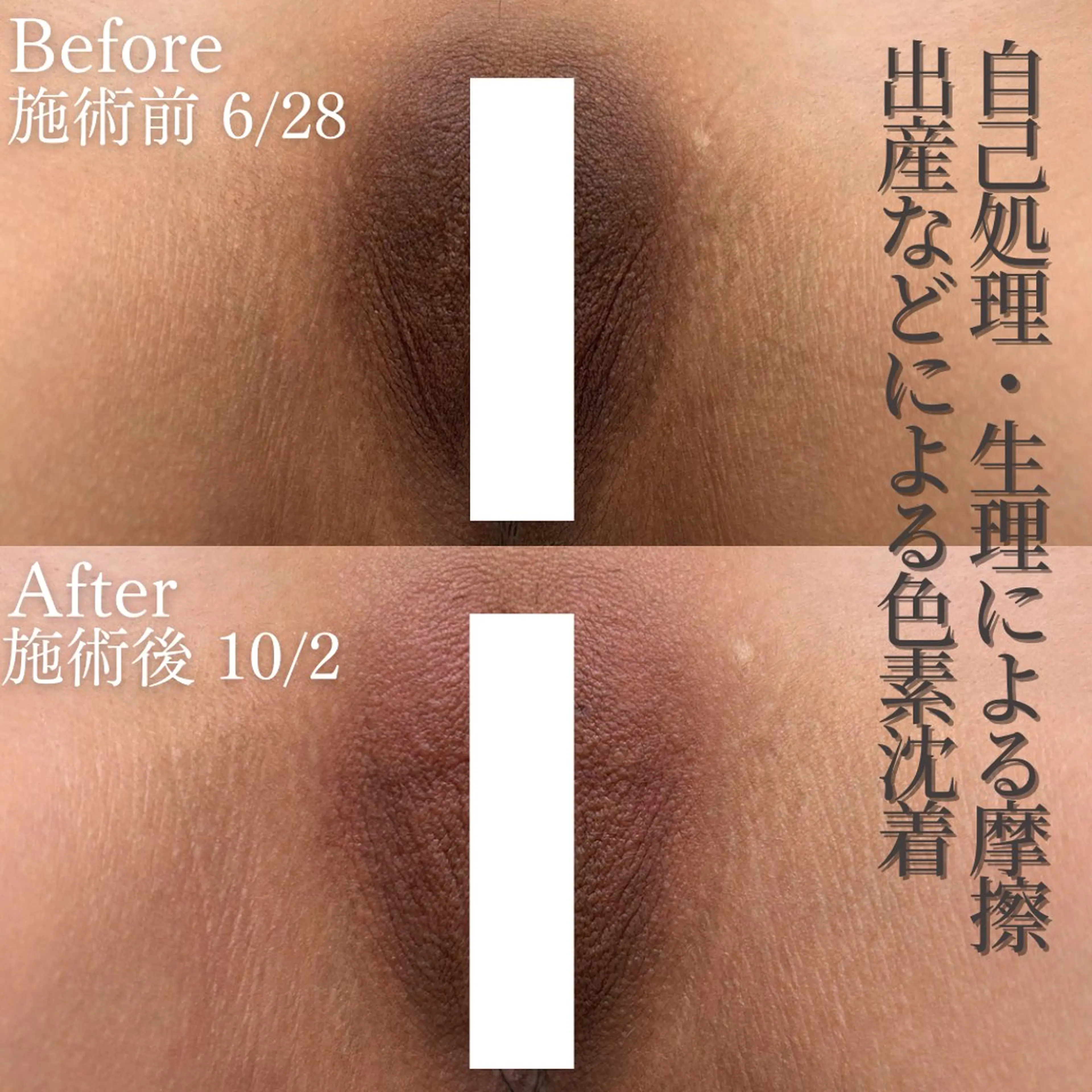 色素沈着・メラニン除去🫧ローマピンク【V・Iライン】の写真