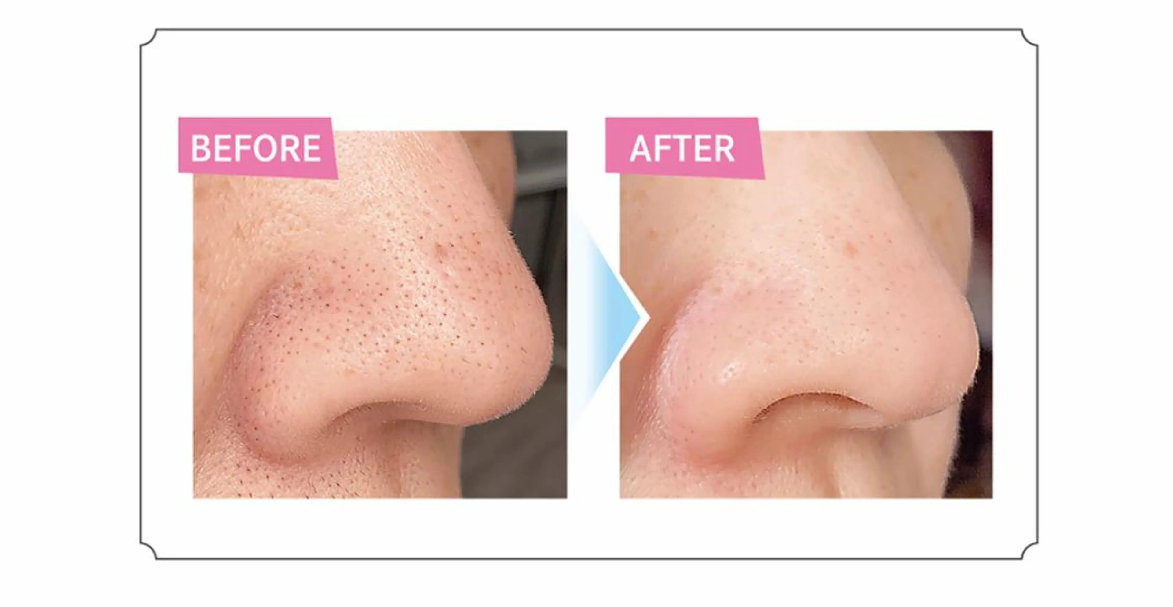 Chalon所属・REVI取扱・肌悩み 毛穴Chalonのエステ・リラクイメージ