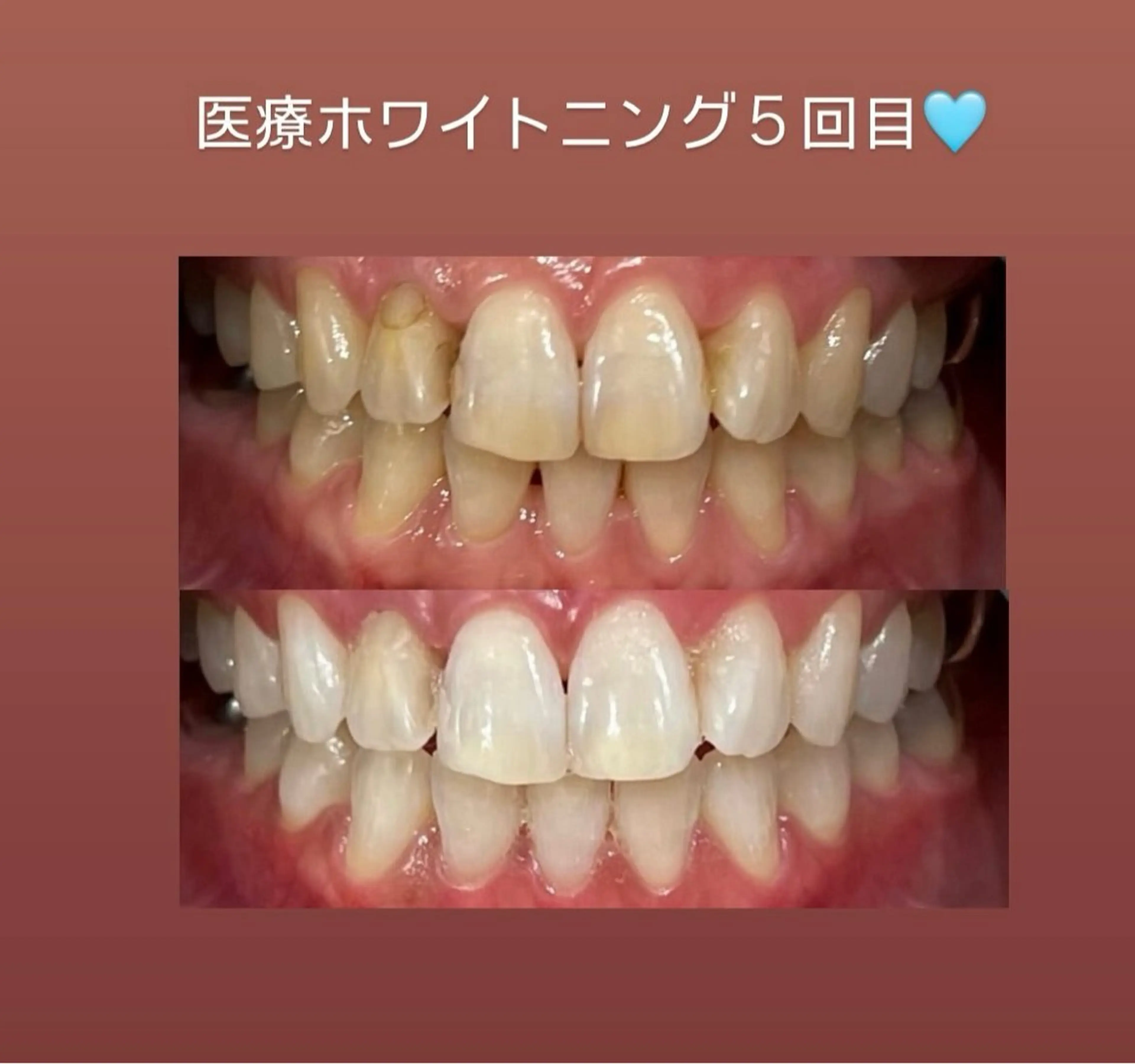Kaula所属・Kaula セルフホワイトニングのその他イメージ