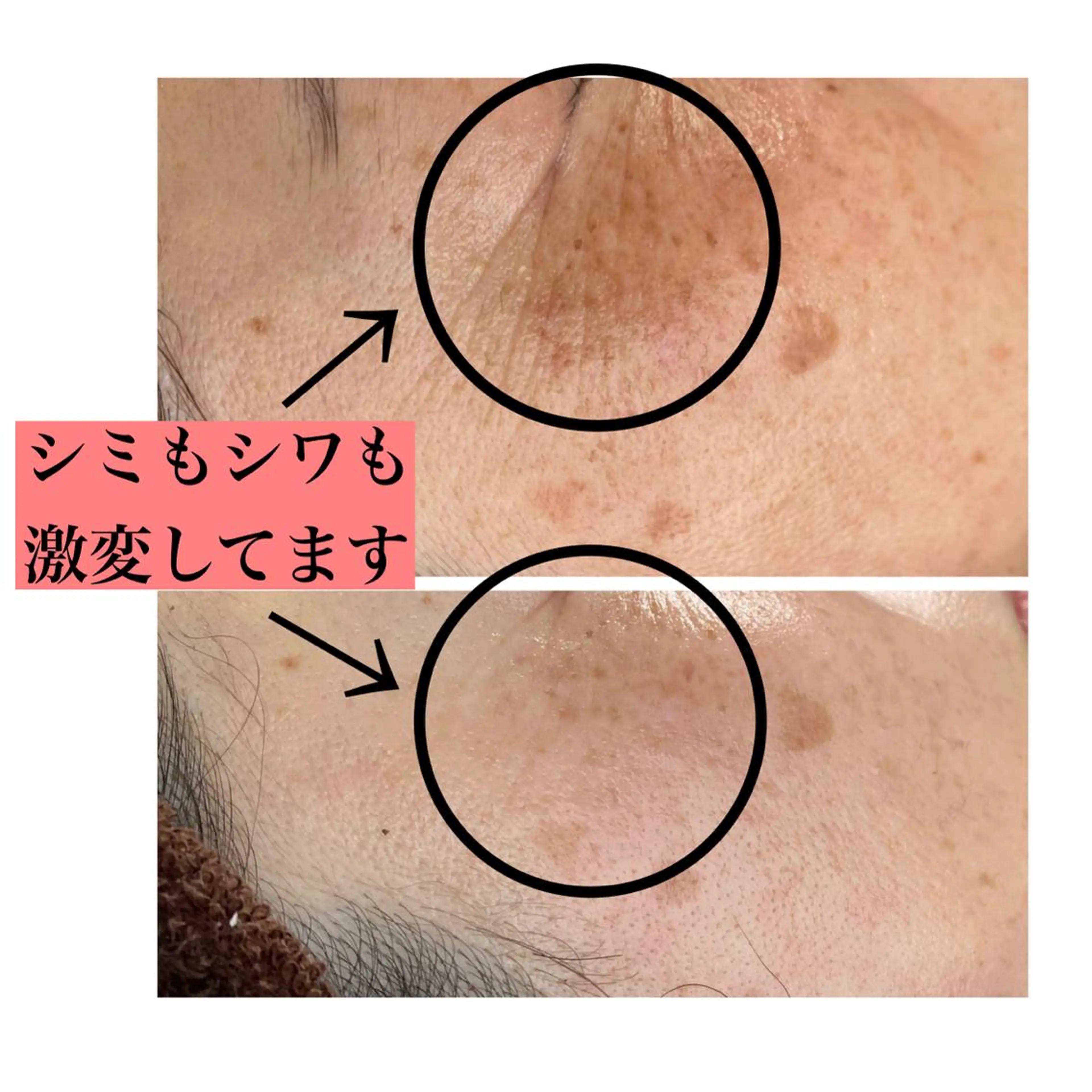 REVIハーブピーリング【35歳以上の方限定】毛穴/シミ/シワ/たるみに今すぐ❣️1週間分のヒト延髄幹細胞美容液付きの写真
