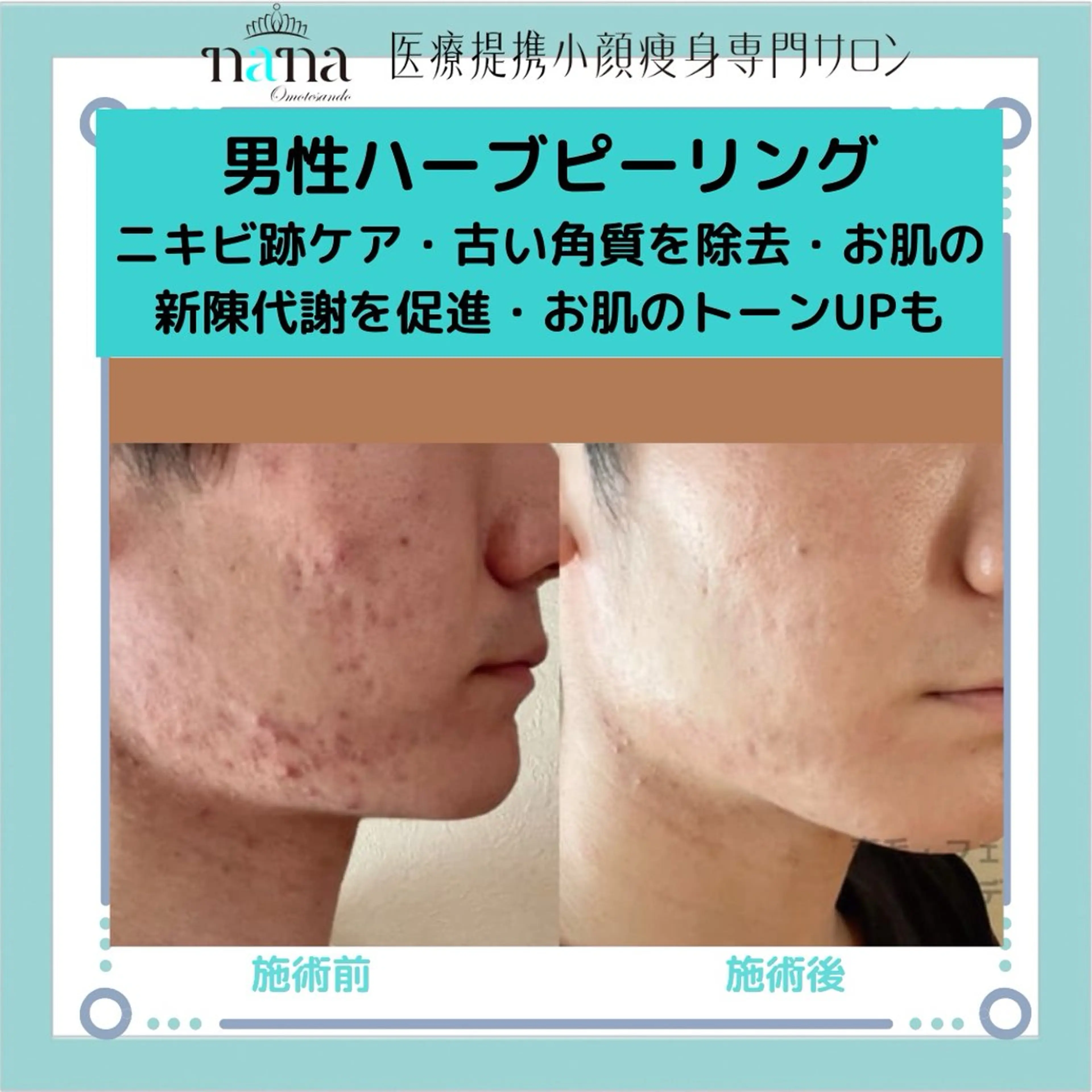 メンズ 小顔痩身インディバ Nana表参道のエステ・リラクイメージ