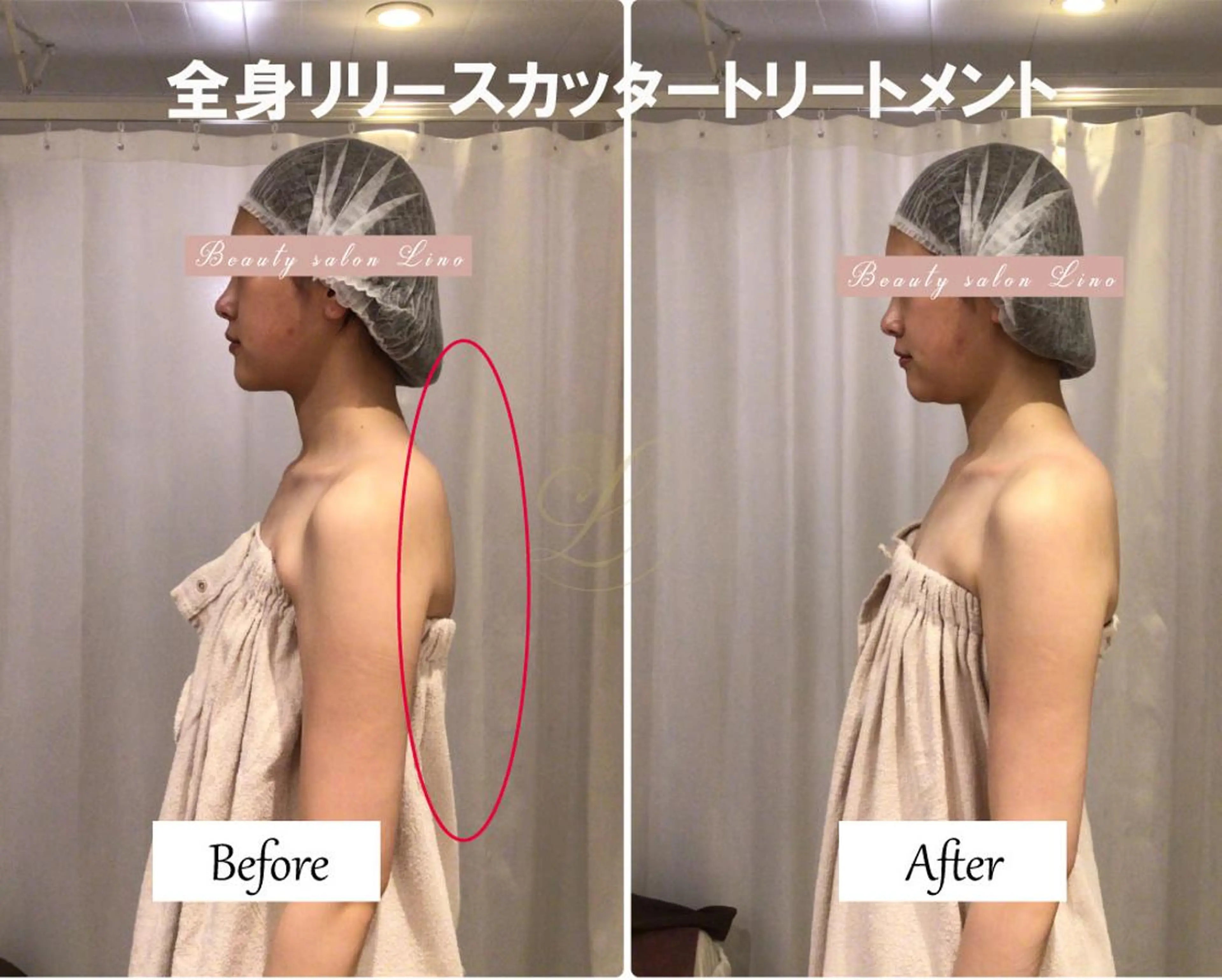肩こり改善 筋膜リリースカッターのエステ・リラクイメージ