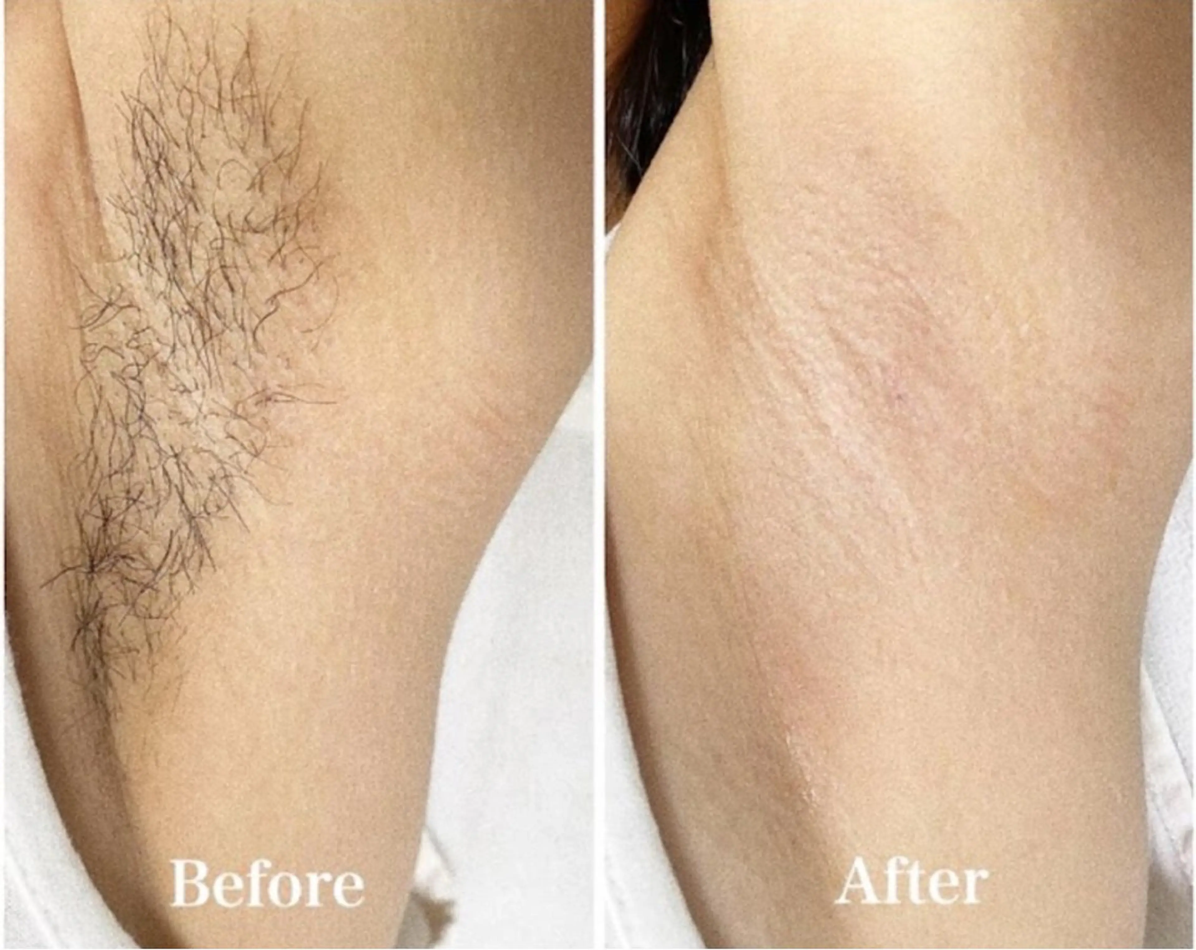 【ワキワックス+光美肌脱毛】¥4,950→¥2,980の写真