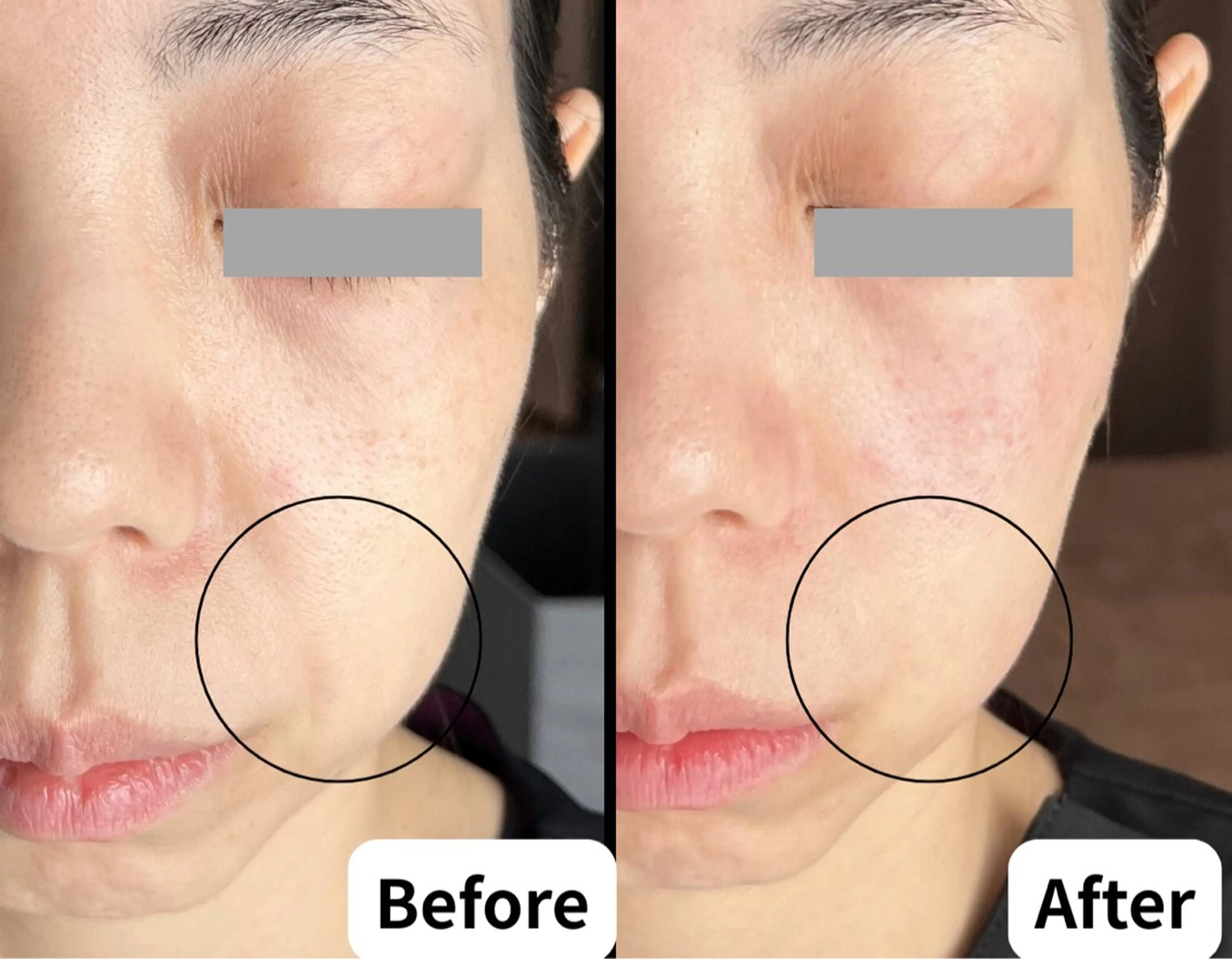 初心者OK★ラジオ波＆炭酸パックでツヤ肌美顔（60分）の写真