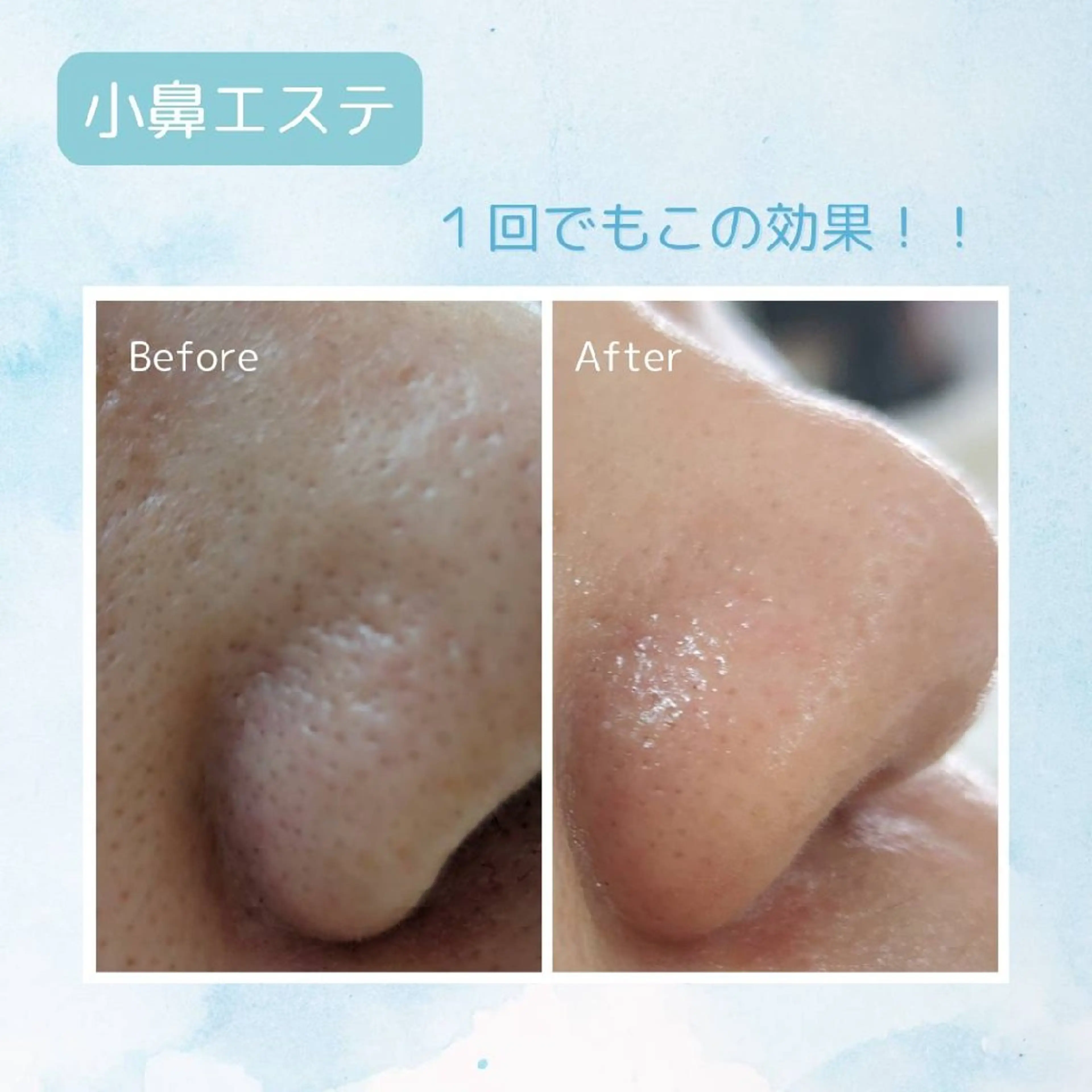 ほったらかしちゃった〜💦気になる小鼻の毛穴ケア❤️‍🔥（単品）の写真