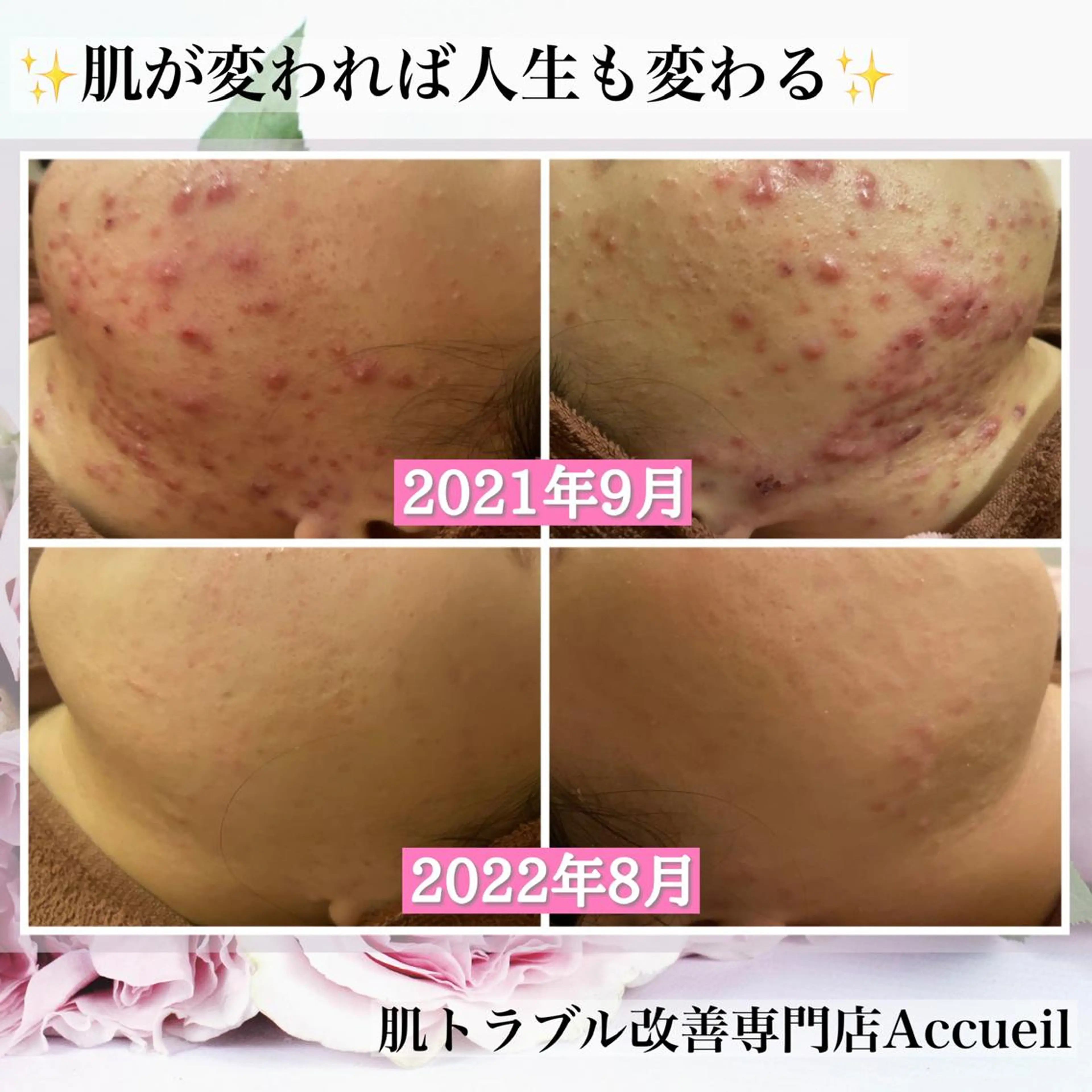セミロング カラー パーマ ヘアアレンジ メンズ キッズ ネイル マツエク・マツパ アイブロウ エステ リラク アクール　齋藤 ♡肌トラブル卒業のエステ・リラクイメージ