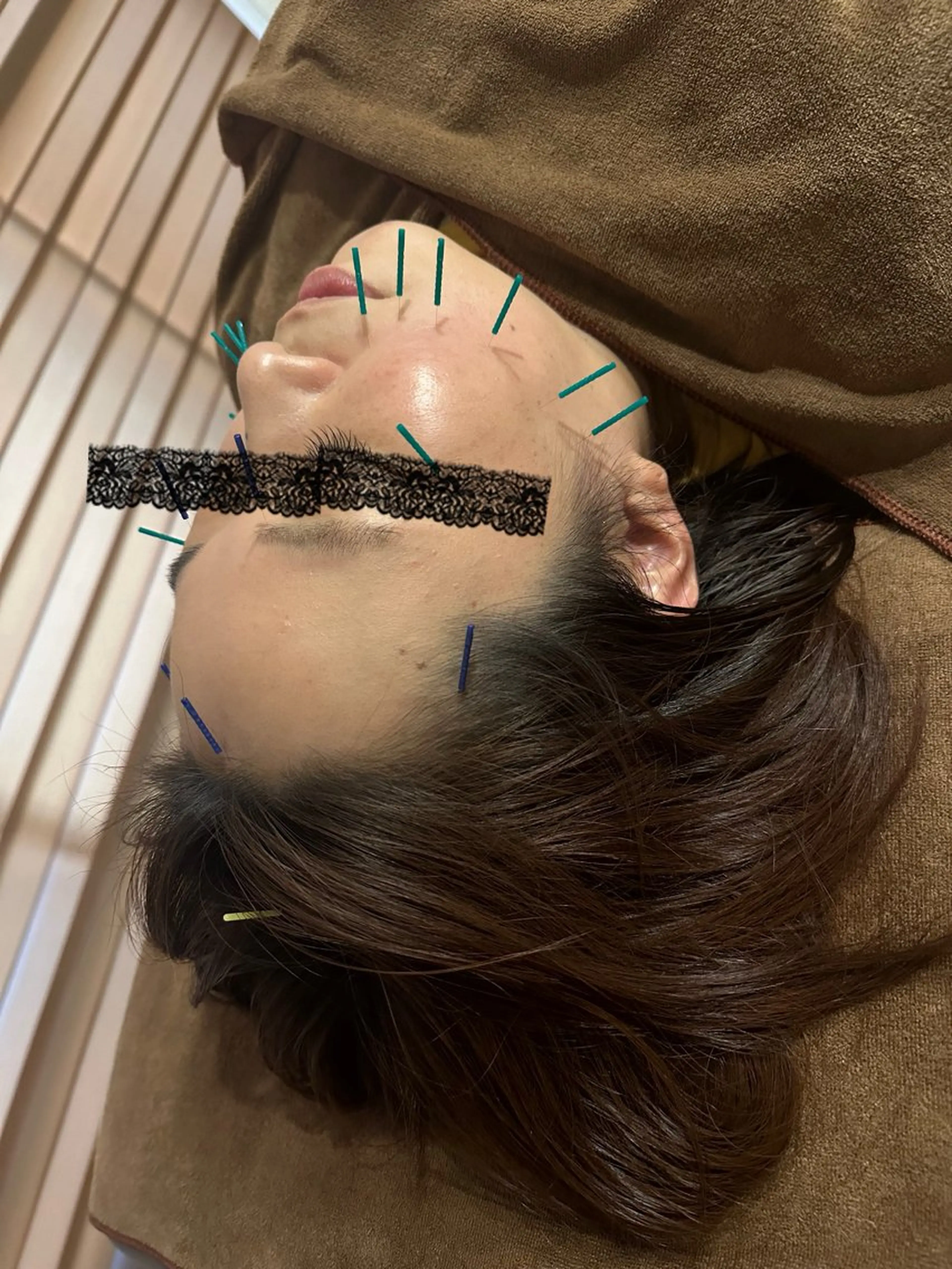 美容鍼の写真