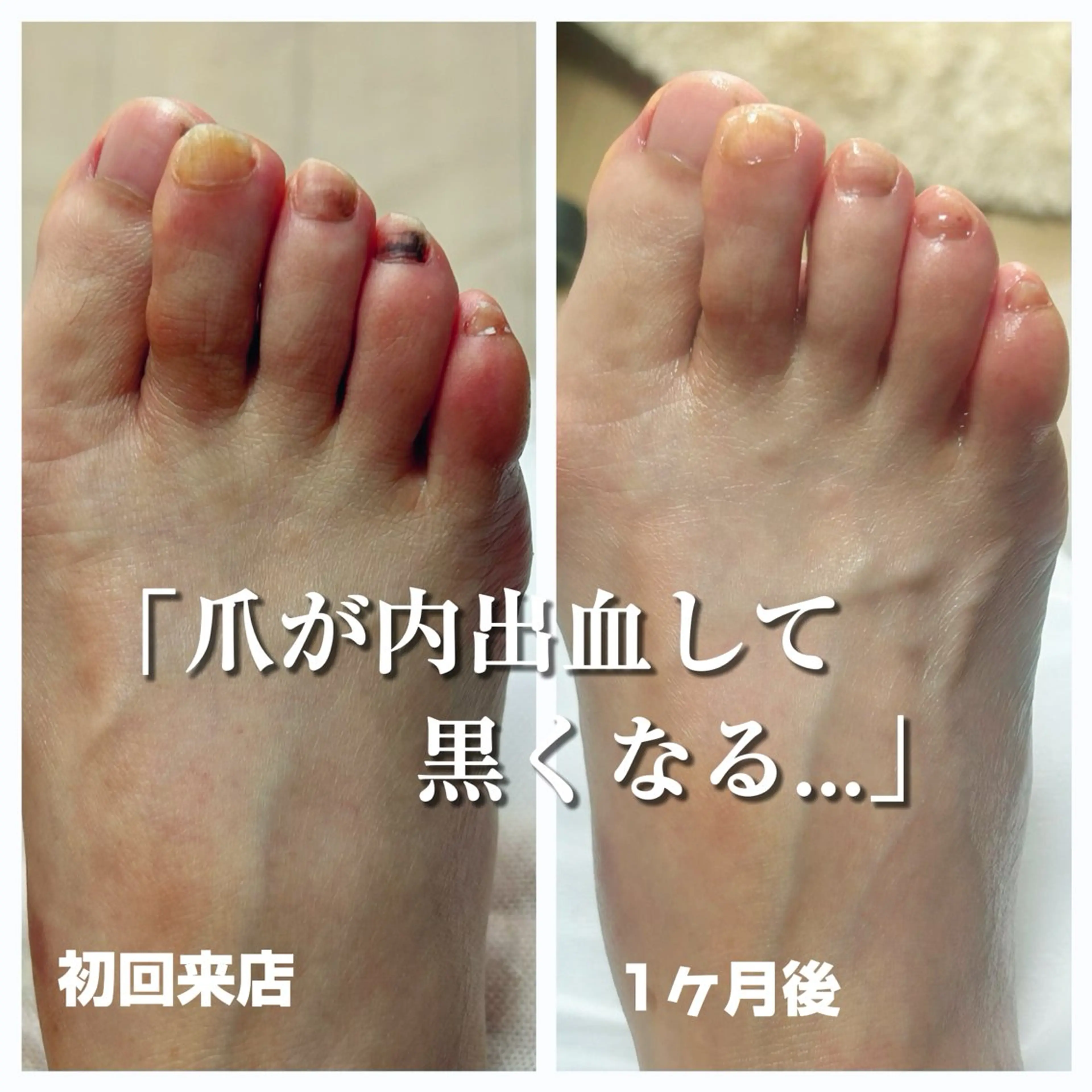 その他 巻き爪フットケアサロンKotori所属・フットケアサロン Kotoriのその他イメージ