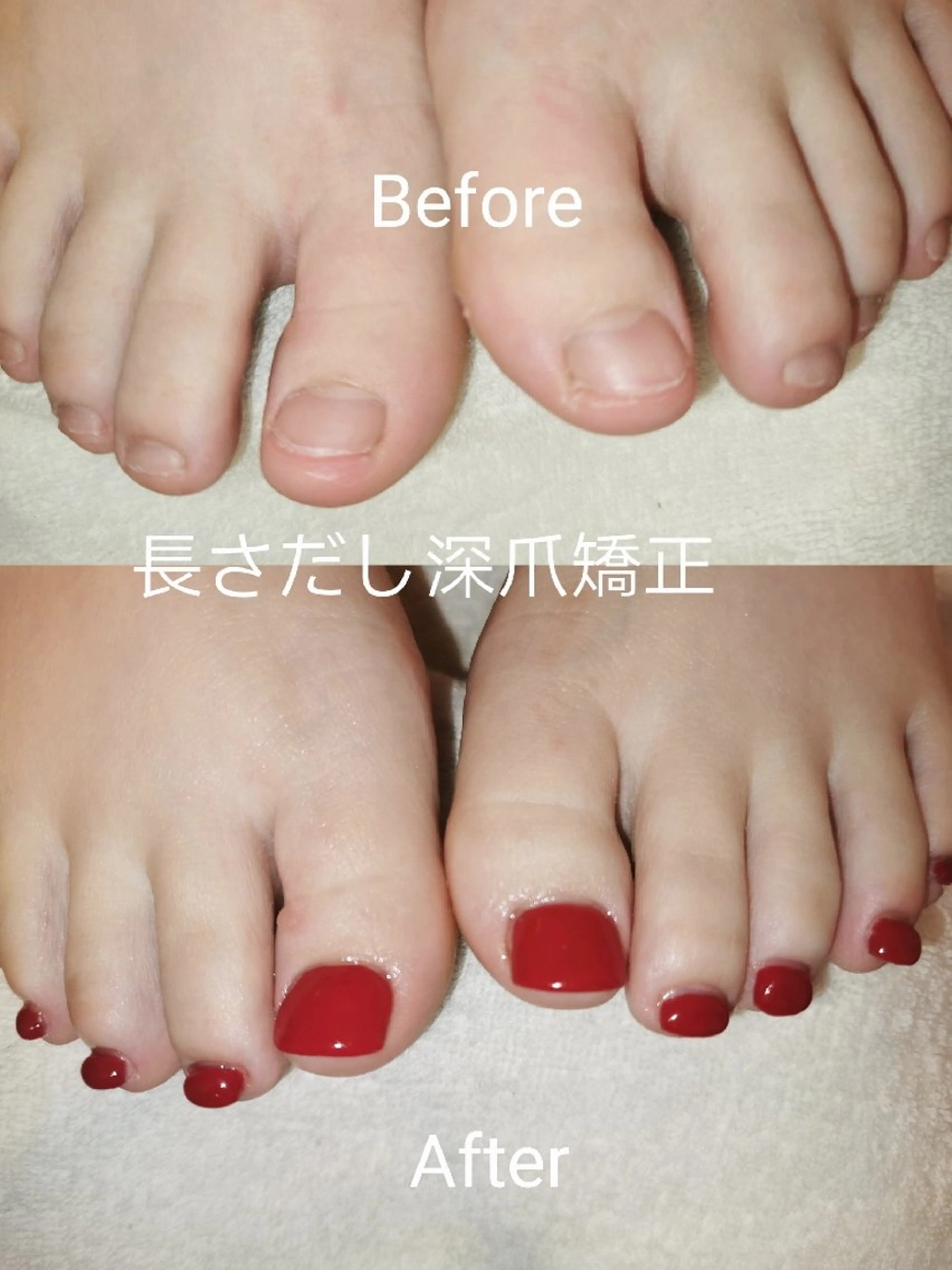 ネイル フットネイル ネイリストゆか💅 長さだし、深爪矯正のネイルデザイン