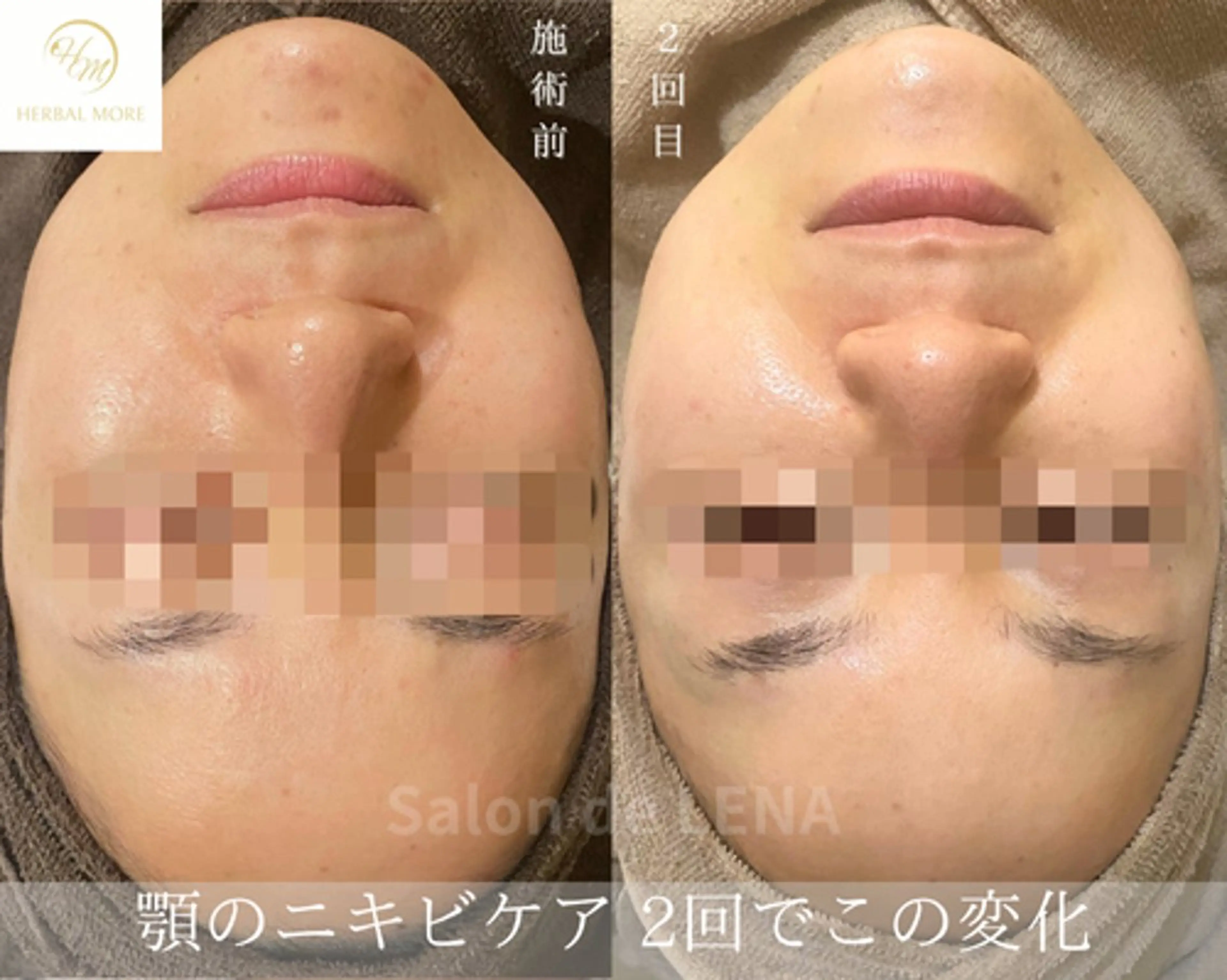 ハーブピーリング・毛穴ケア専門サロンSalon de LENA 栄店所属・ハーブピーリング専門 サロンドレナ　白藤のエステ・リラクイメージ