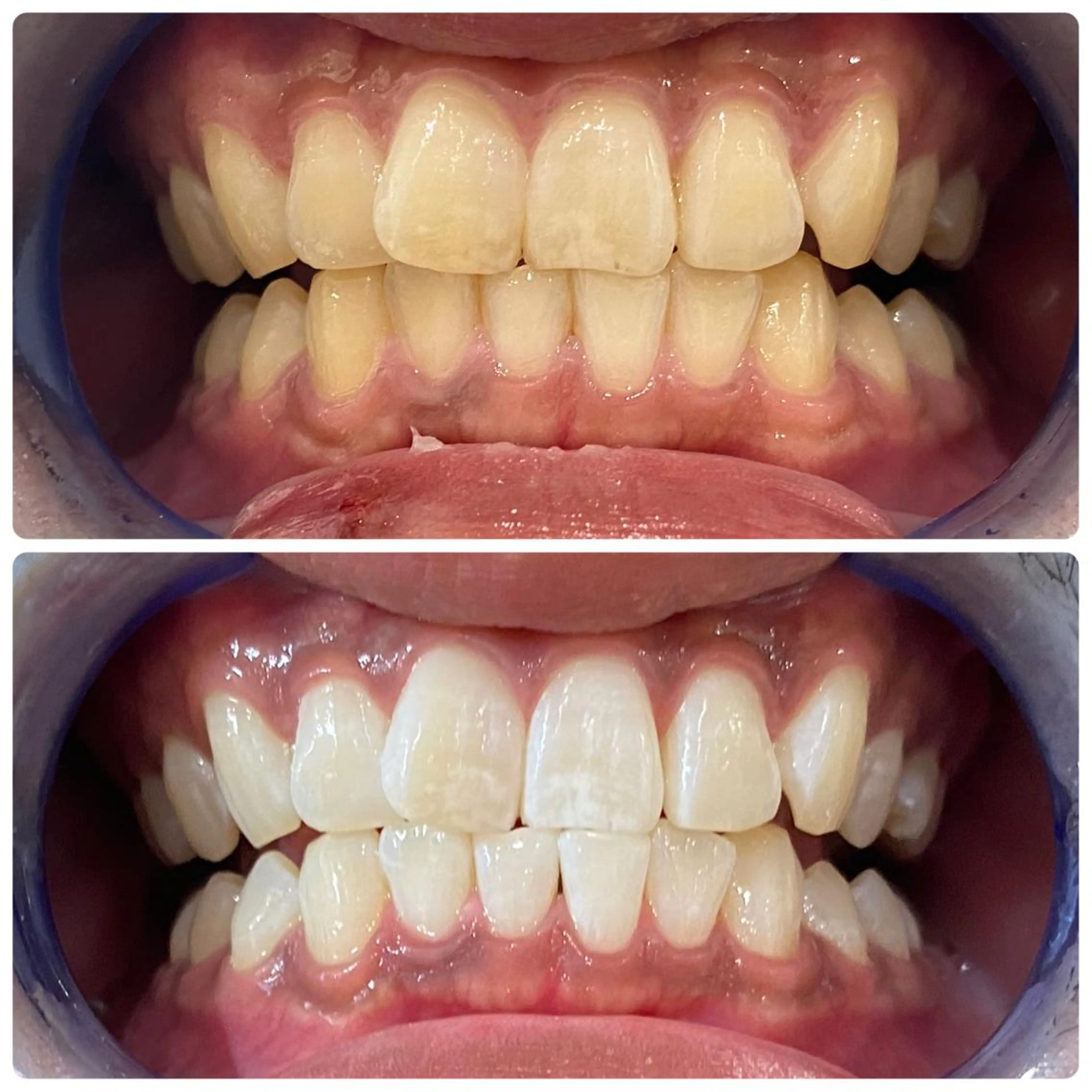 その他 White Berry SELF BEAUTY SALON所属・セルフホワイトニング 🦷口元垢抜け✨のその他イメージ