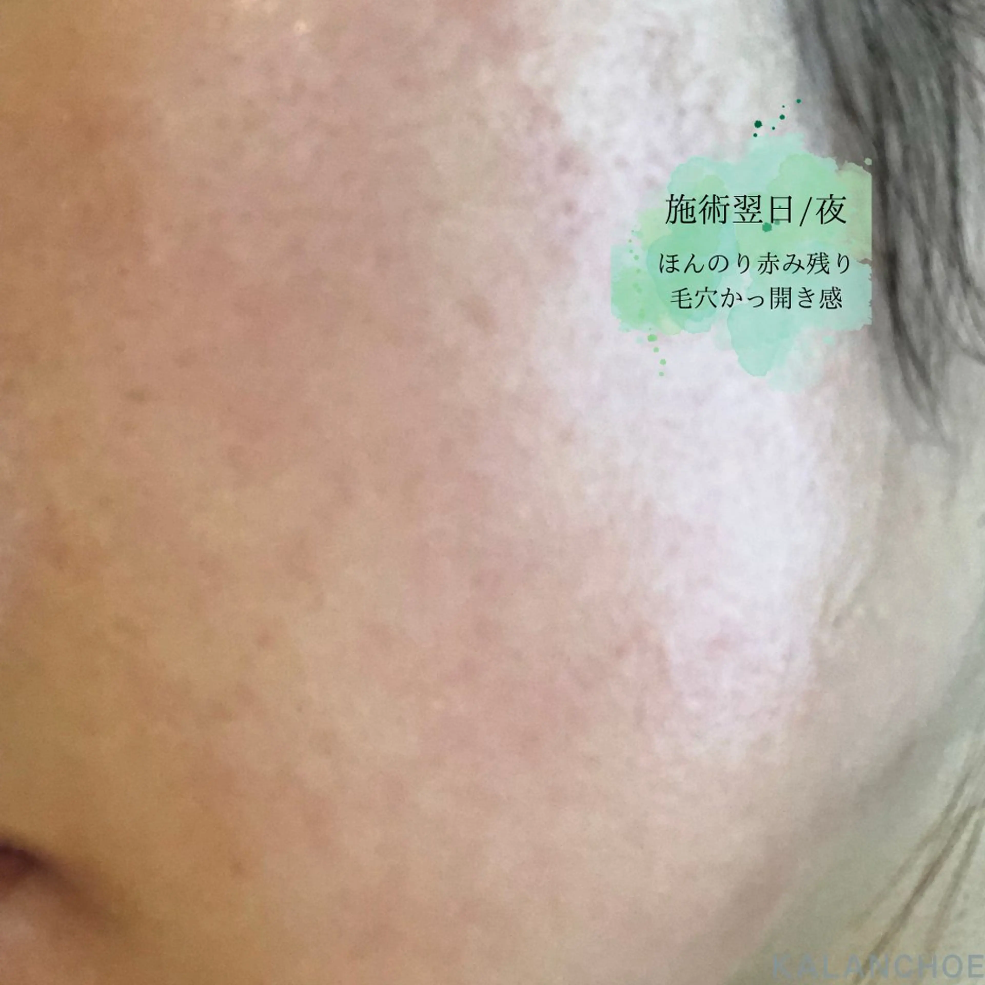 エステ 肌質改善 KALANCHOEのエステ・リラクイメージ