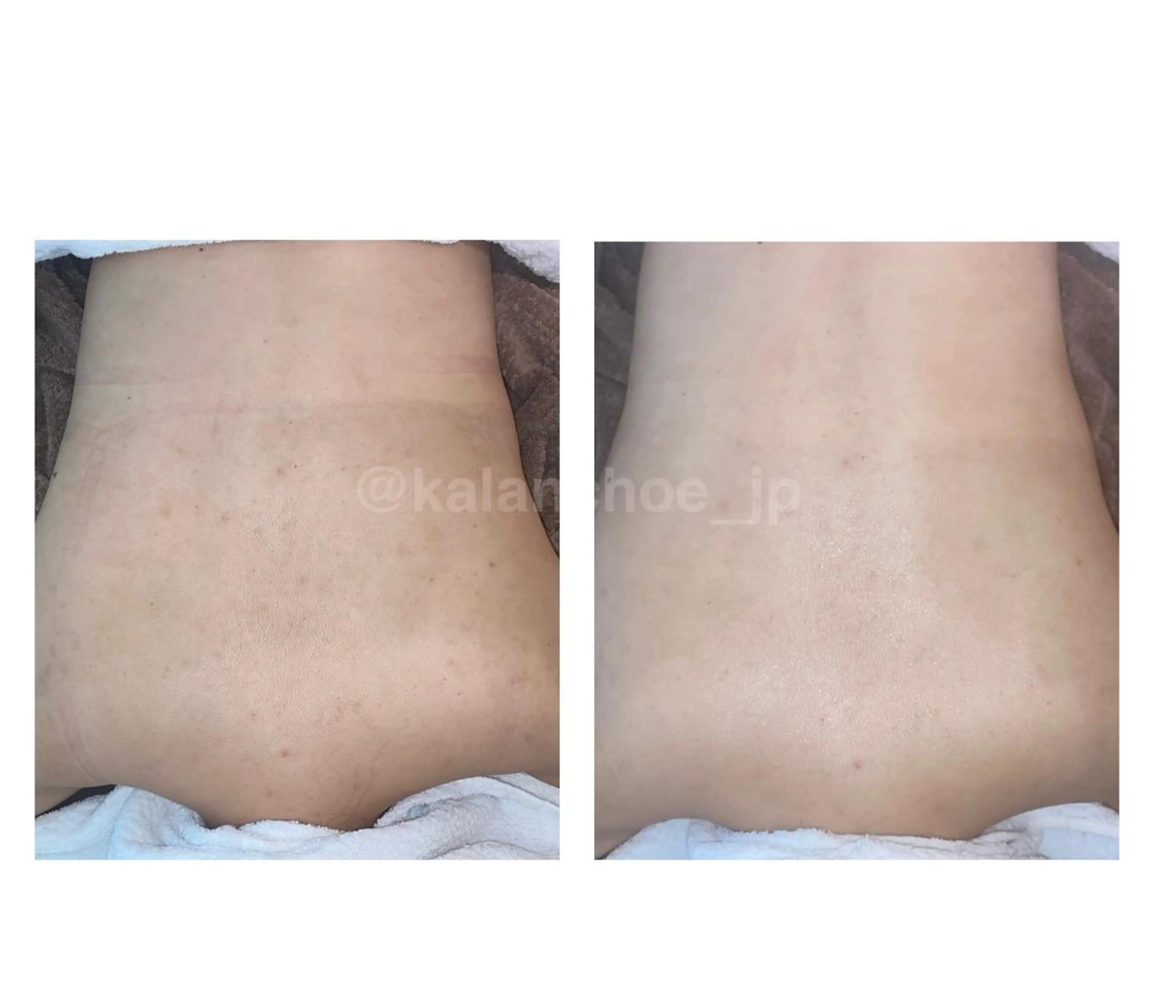 肌質改善 KALANCHOEのエステ・リラクイメージ