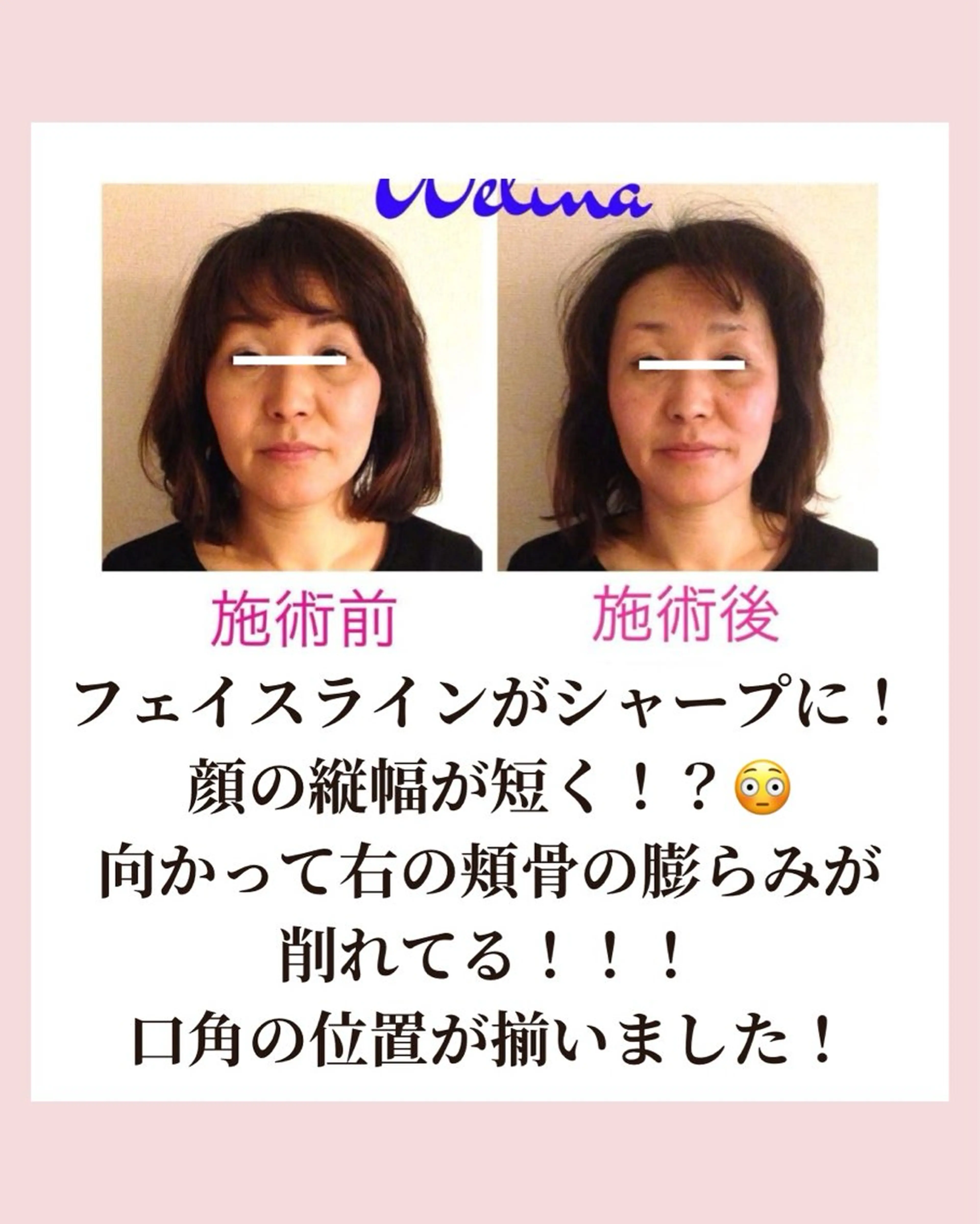 痩身・小顔・骨盤矯正×ヒップアップ専門エステ Peach所属・桃尻つかさ🍑小顔× ノーファンデ肌作りのエステ・リラクイメージ