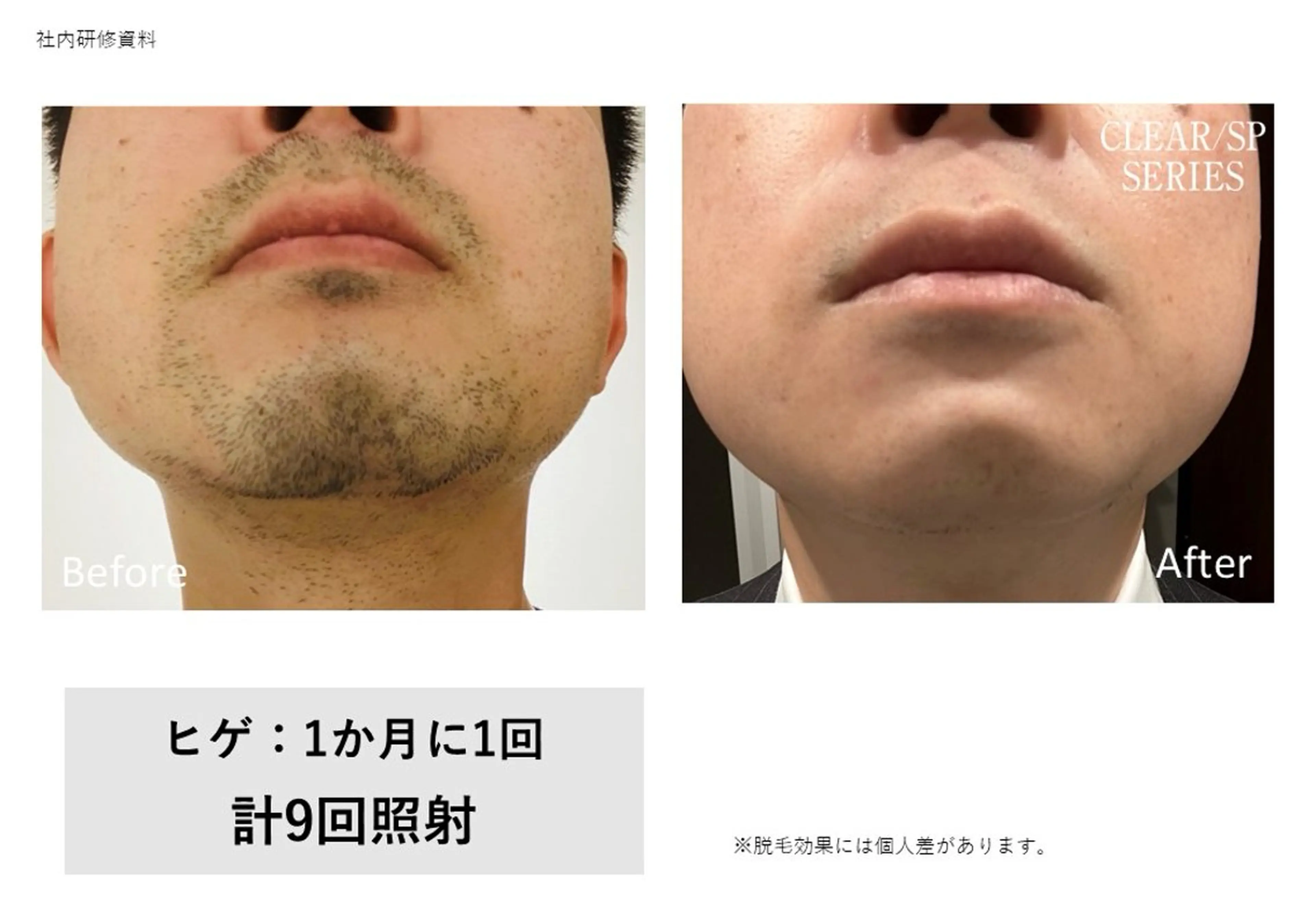 【メンズ】髭脱毛（顔全体OK）痛みの少ないTHR脱毛♪の写真