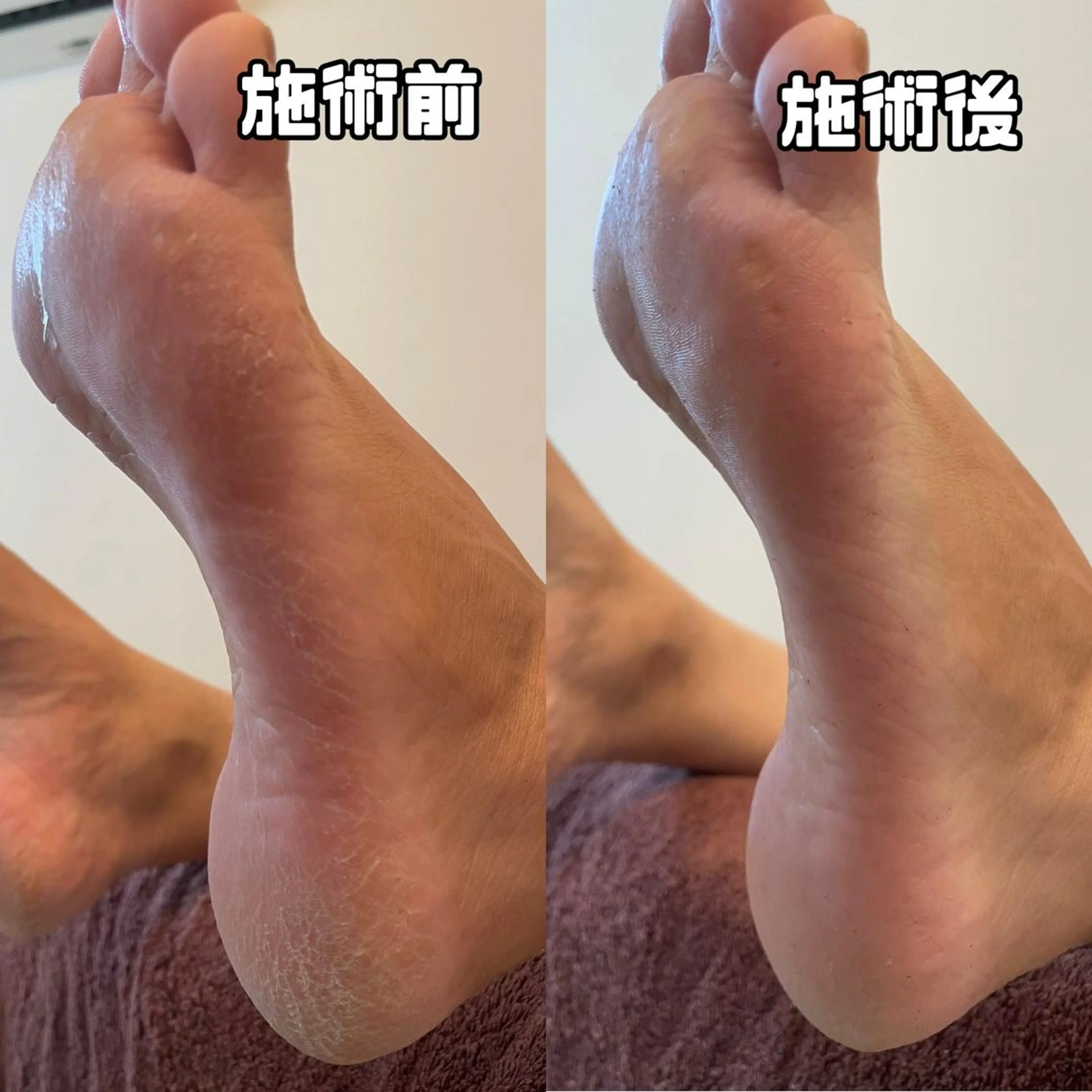 フットネイルとフットケアセットの写真