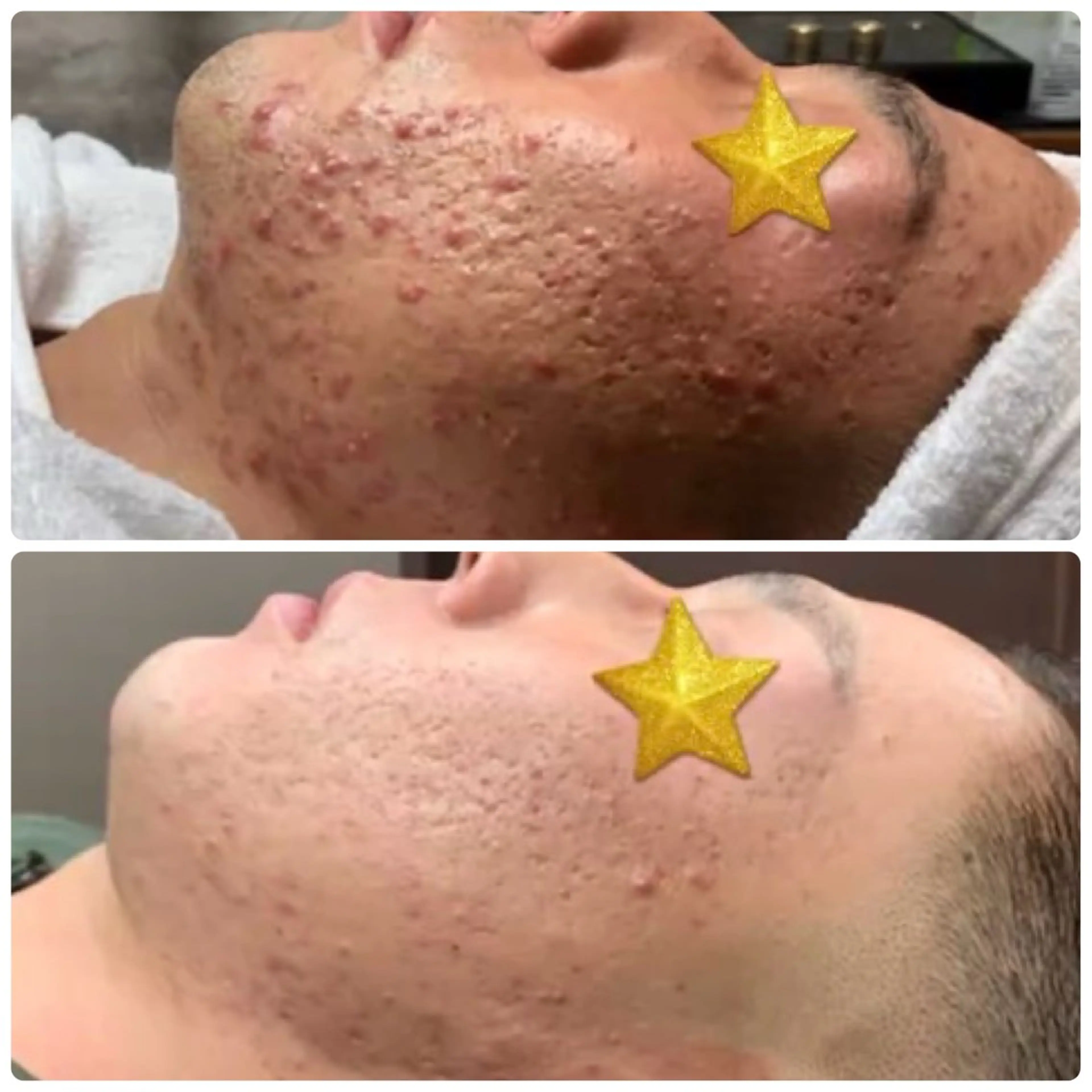 【背中ニキビに】VOSトリートメントで、できてしまったニキビを改善します。￥22.000→￥11.000  他返金有♪の写真