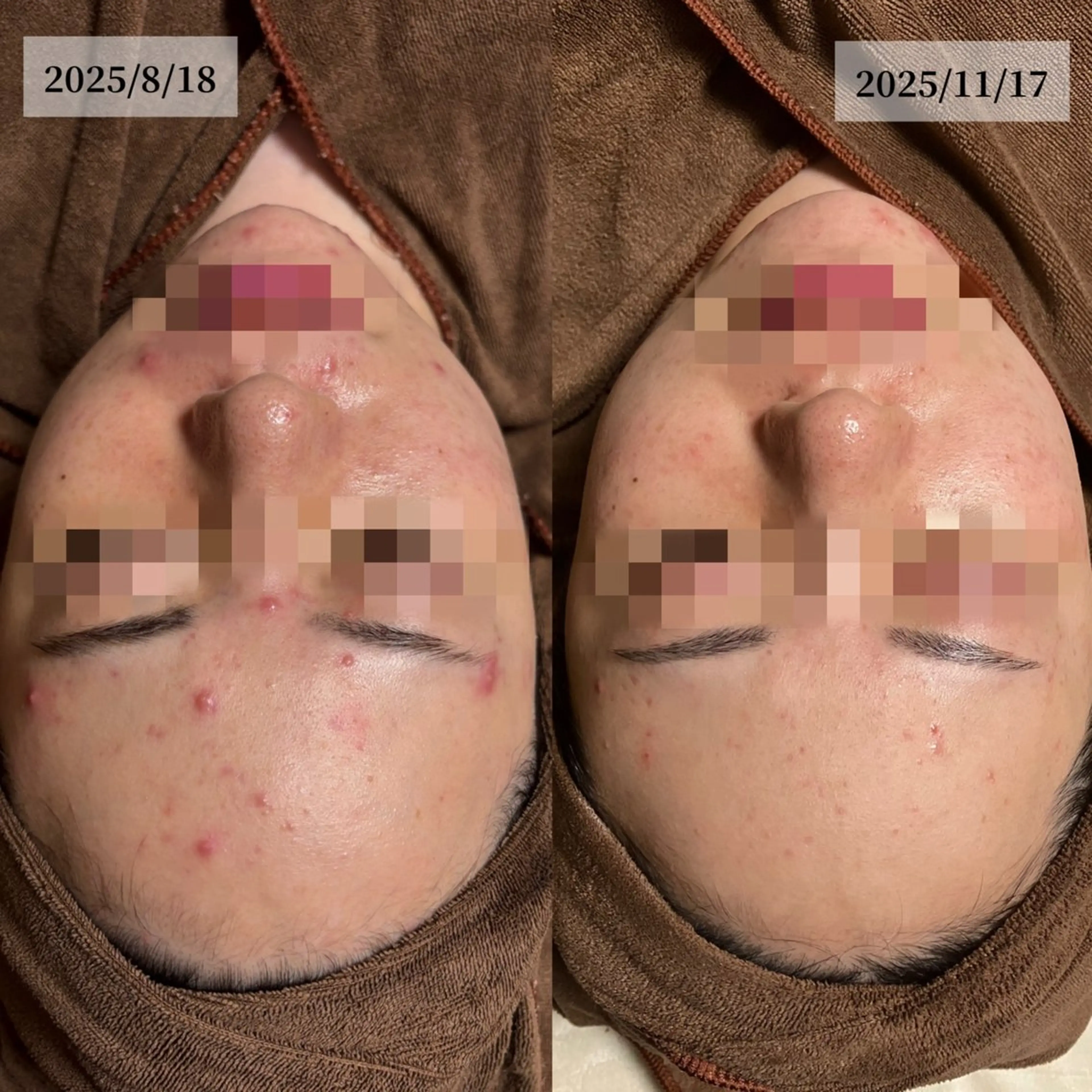 エステ HINANO矢場町店【ヒナノ】所属・脱毛/肌改善🌿 HINANO 村田のエステ・リラクイメージ