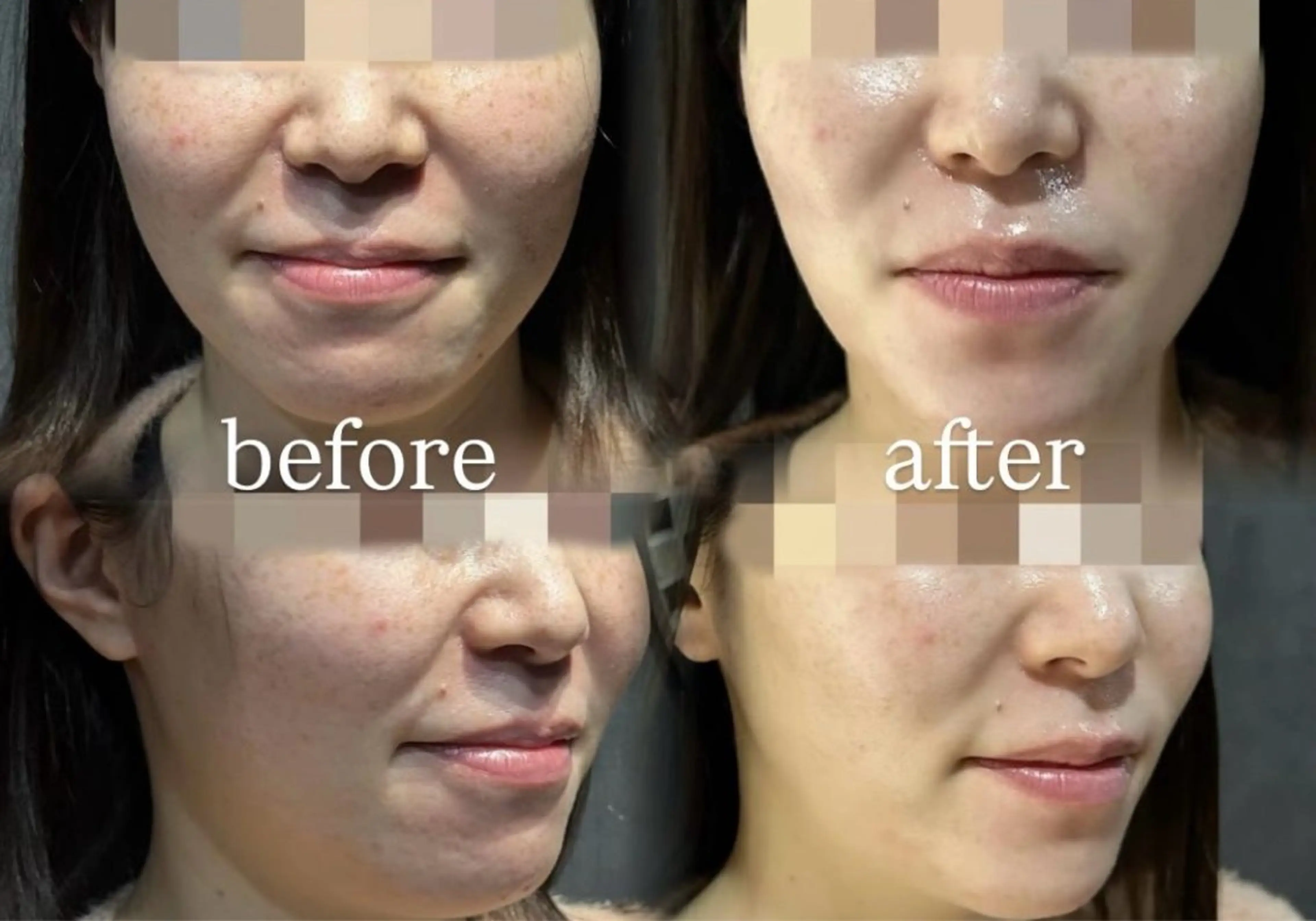 【1日2名限定】肌管理モニター🫧毛穴・ニキビ・赤み・ザラつき改善／フェイシャル歴6年以上のベテランスタッフ施術✨の写真