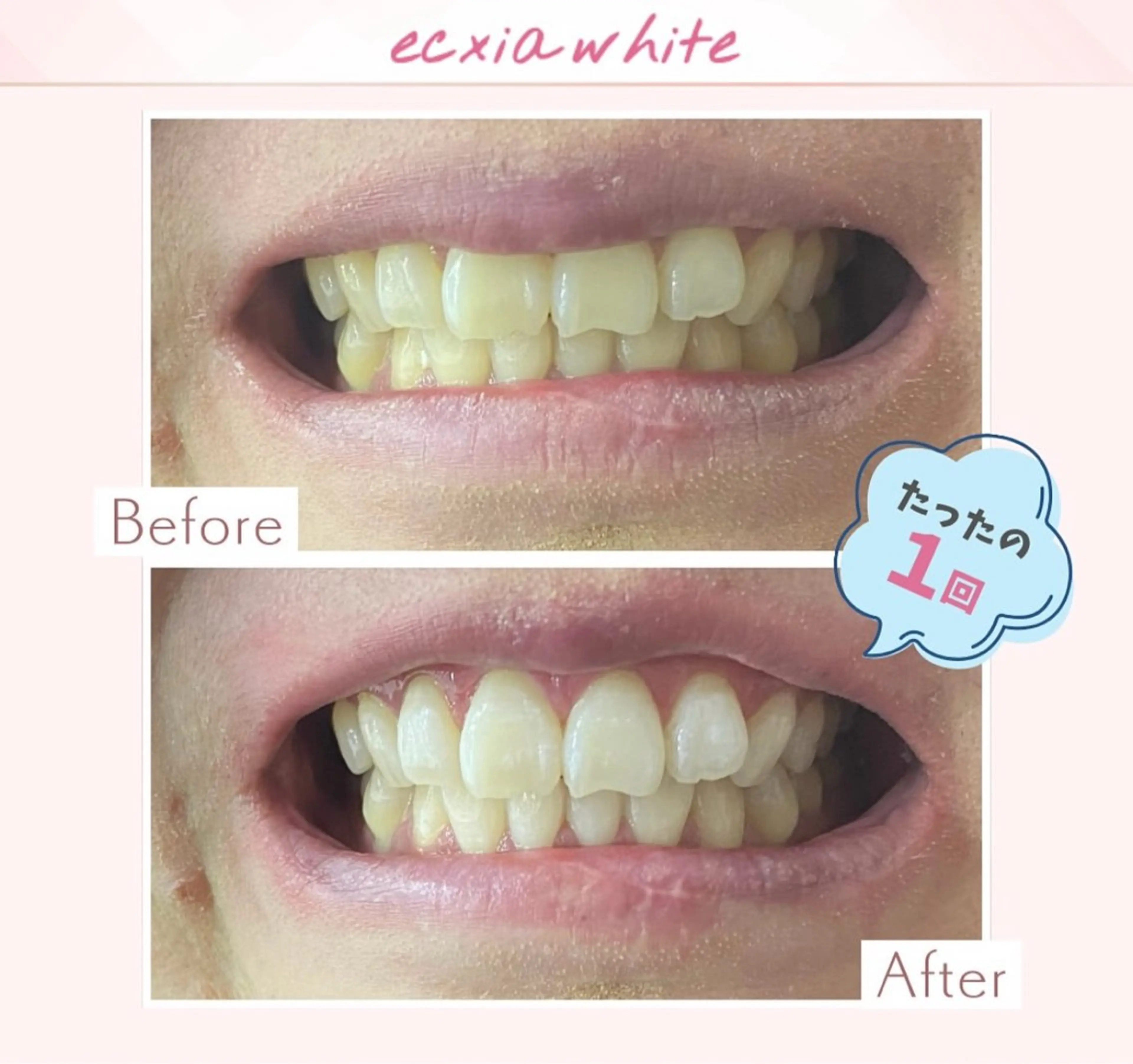 エクシアホワイト調布所属・セルフホワイトニング エクシア調布店のその他イメージ