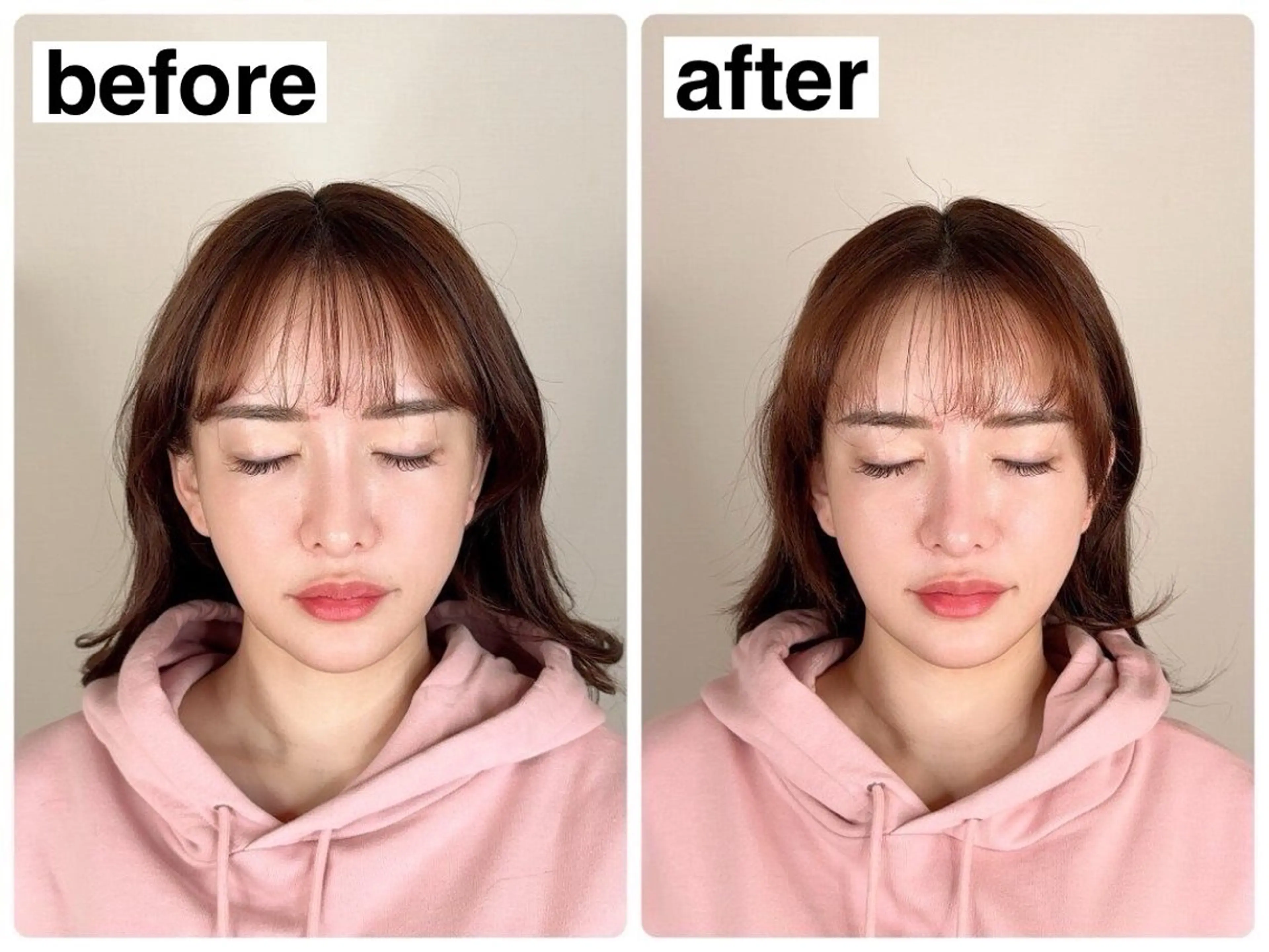 【新人スタッフクーポン】【エラ張り改善】エラ張り集中小顔コース ¥12,000→¥1,000の写真