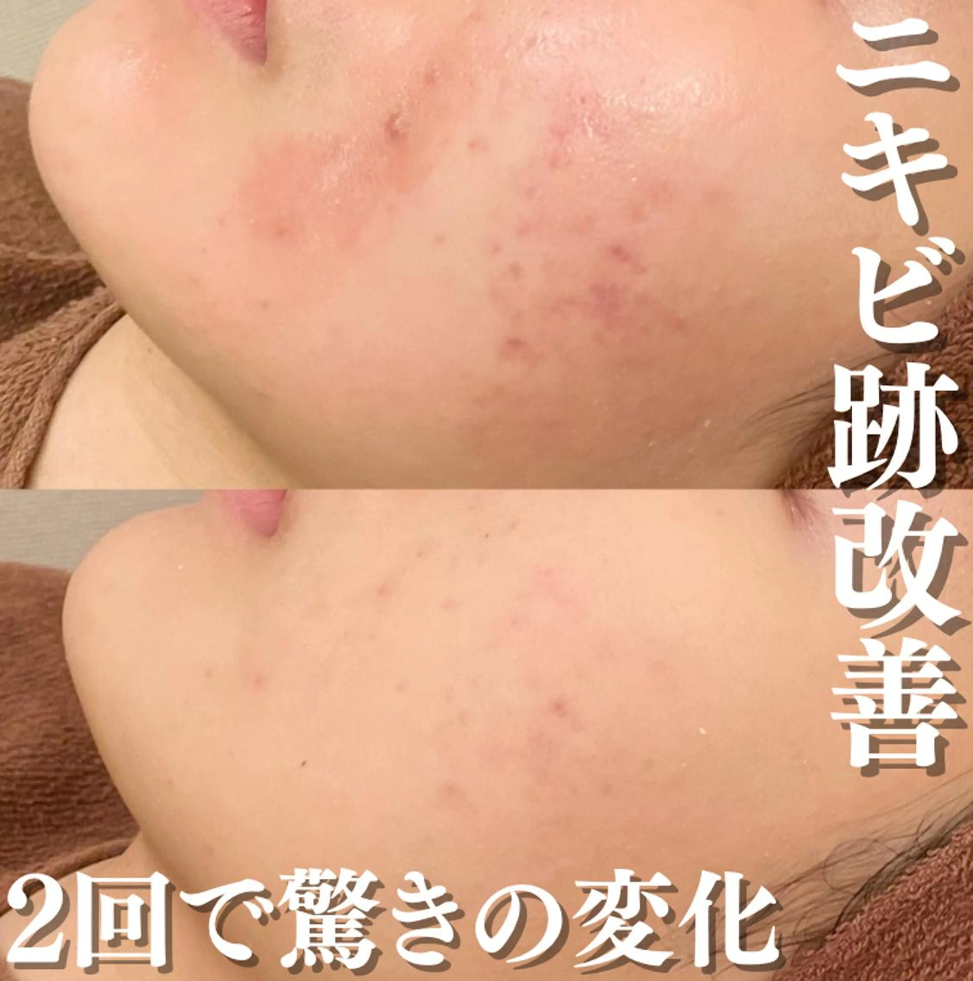 エステ リラク ニキビ跡改善専門🔥 医療にはできない改善のエステ・リラクイメージ