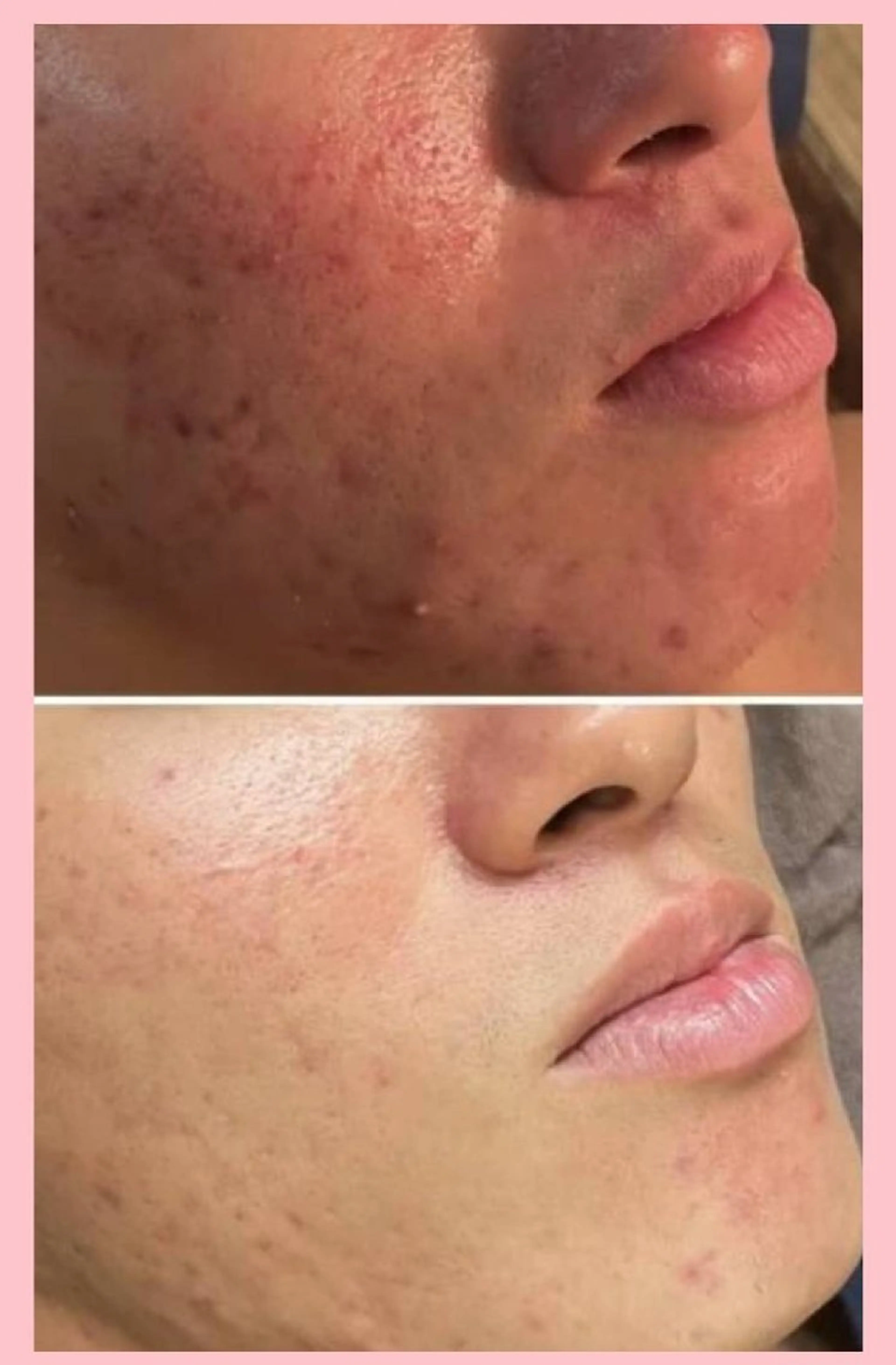 メンズ人気🌿ハーブピーリングノーマル＆角質洗浄＆鼻クレンジング🌿吹き出物、吹き出物跡、毛穴、黒ずみ、脂性肌に👍️の写真