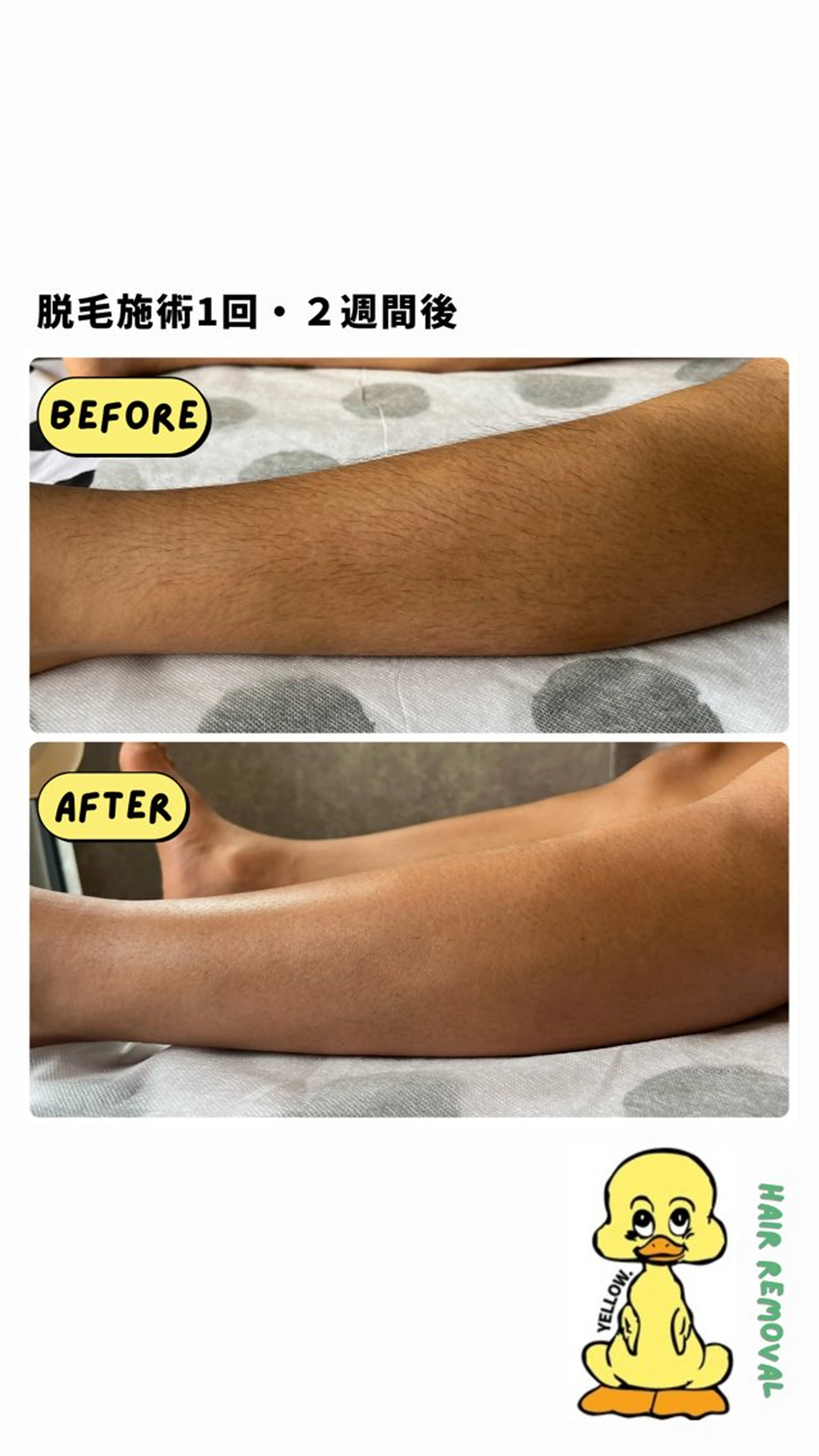 脱毛 yellow.所属・yellow💛【 脱毛&フェイシャル】のエステ・リラクイメージ