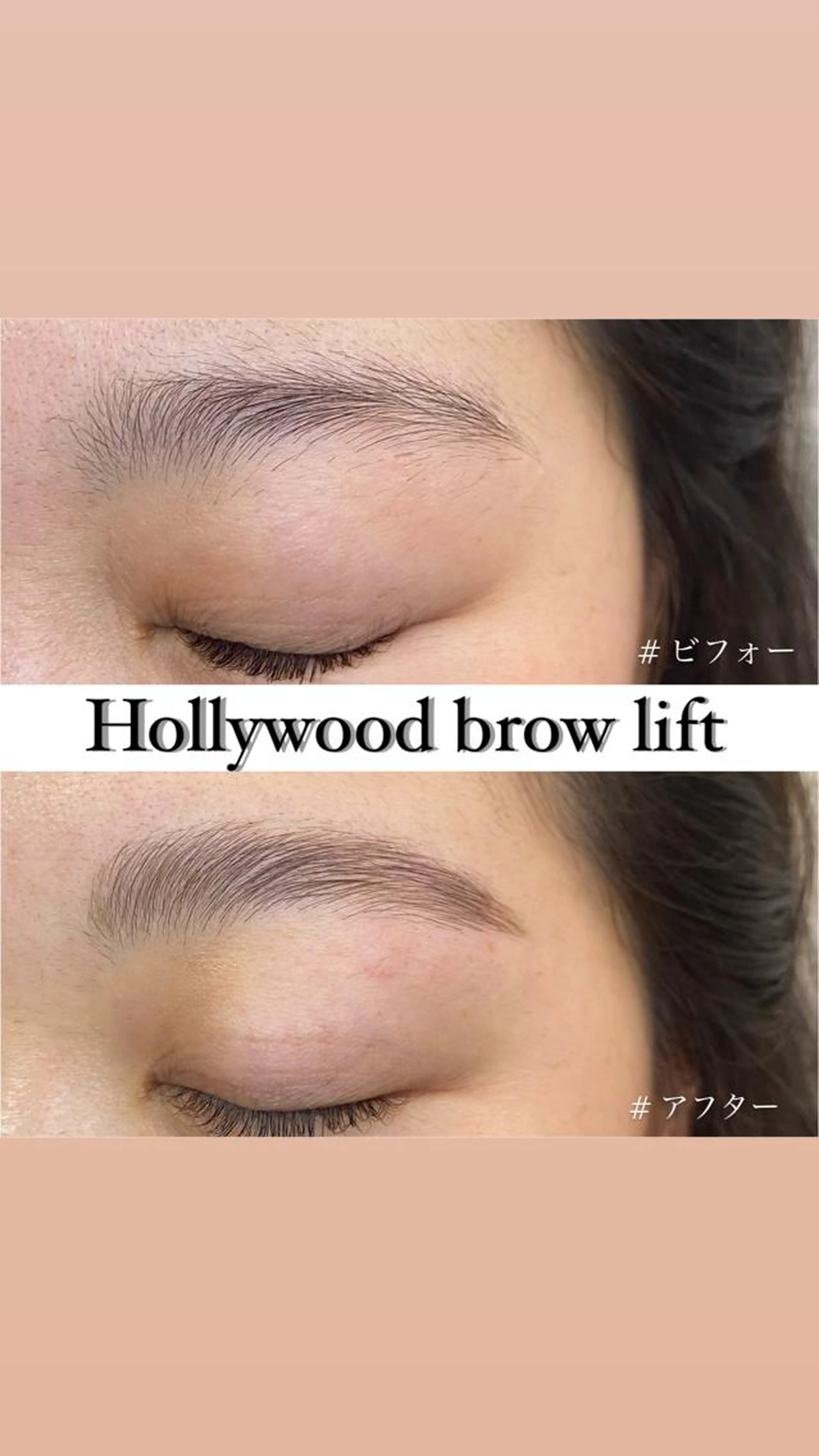 hollywood brow lift (注意事項⚠️必須)の写真