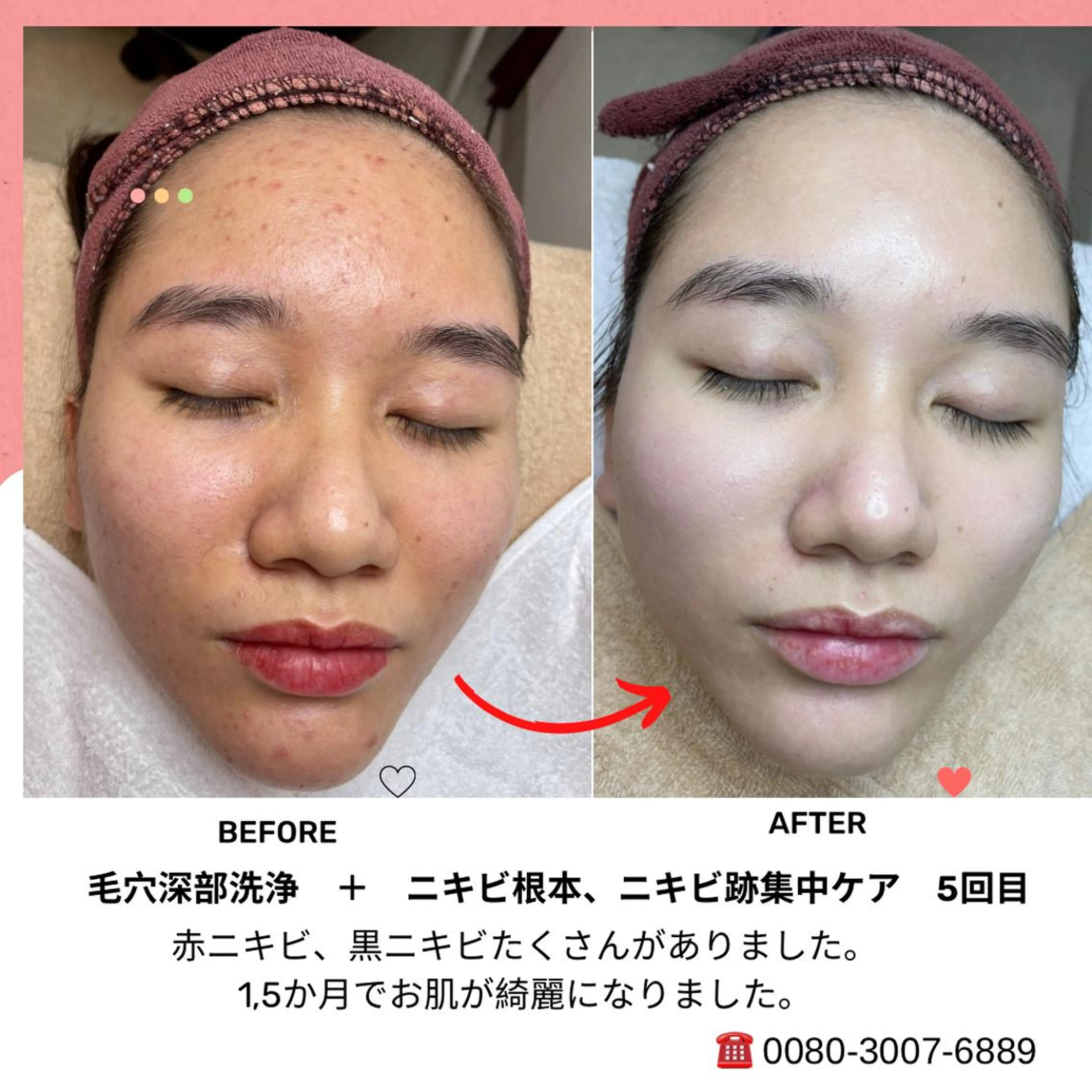 ニキビ、痩身、脱毛、 サクラチャンスパのエステ・リラクイメージ