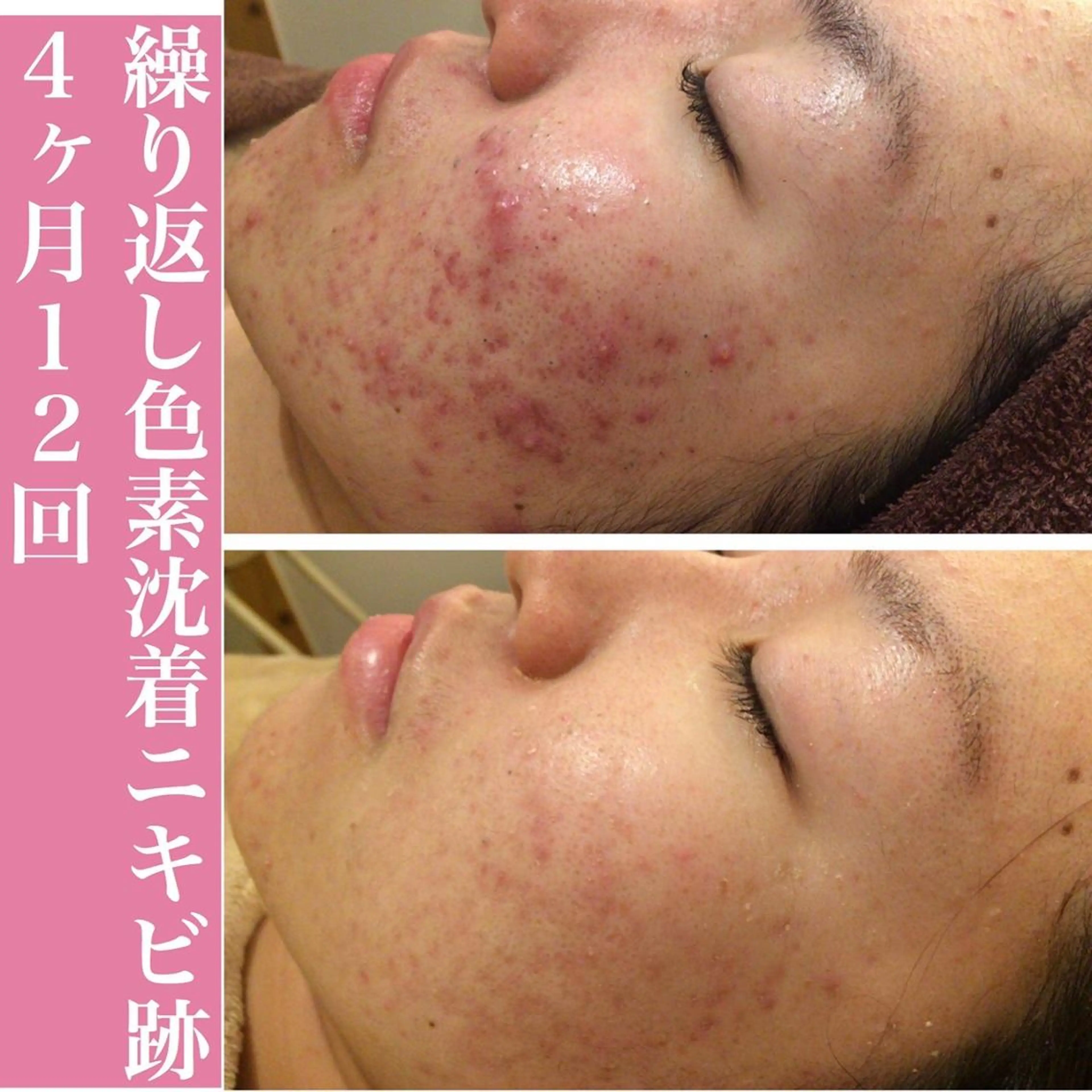 皮膚科より効果あり ⁉️最短ニキビ改善のエステ・リラクイメージ