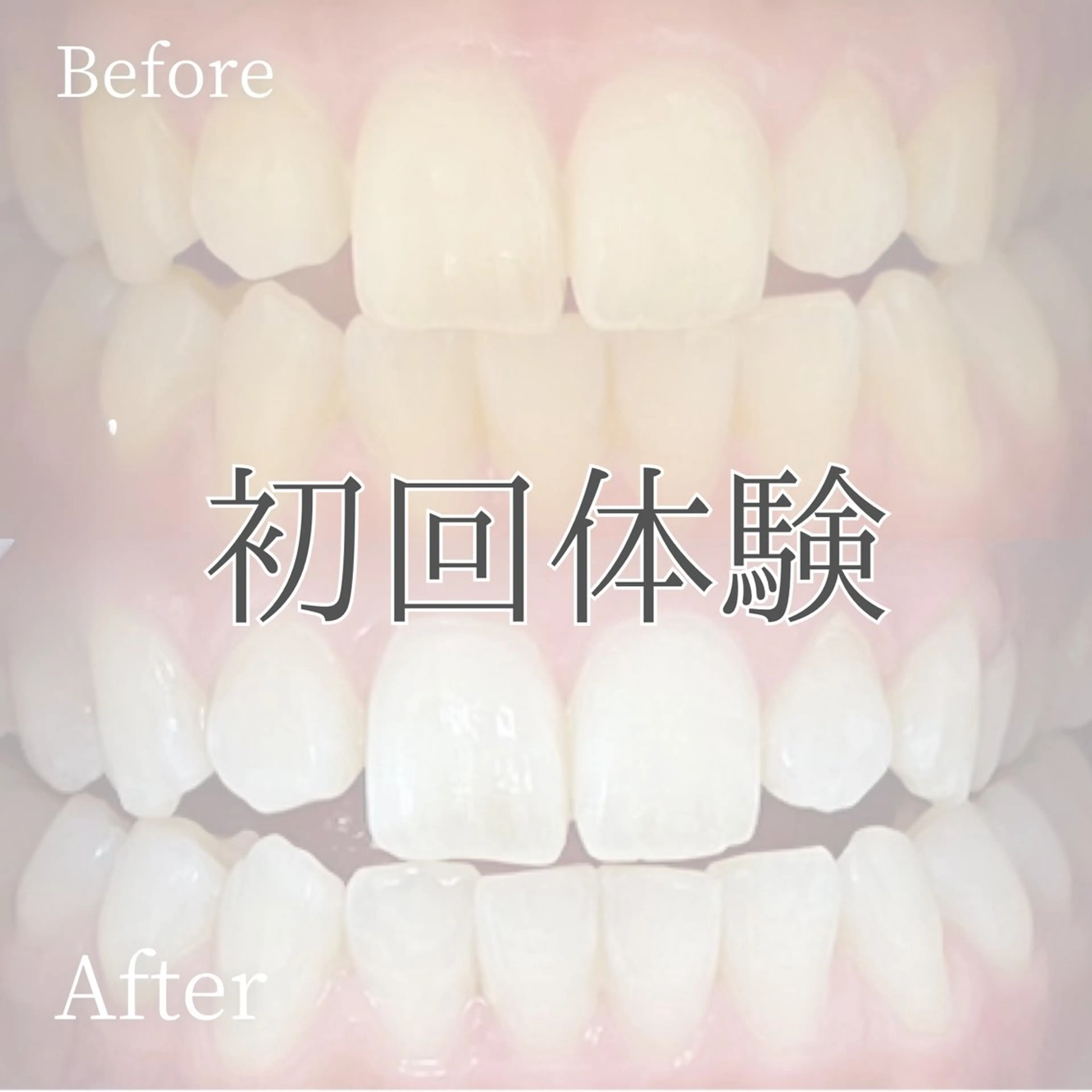 【ミニモ限定】初回体験✨40分¥2500ホワイトニングデビューは当店におまかせ✨口コミ必須🫶の写真