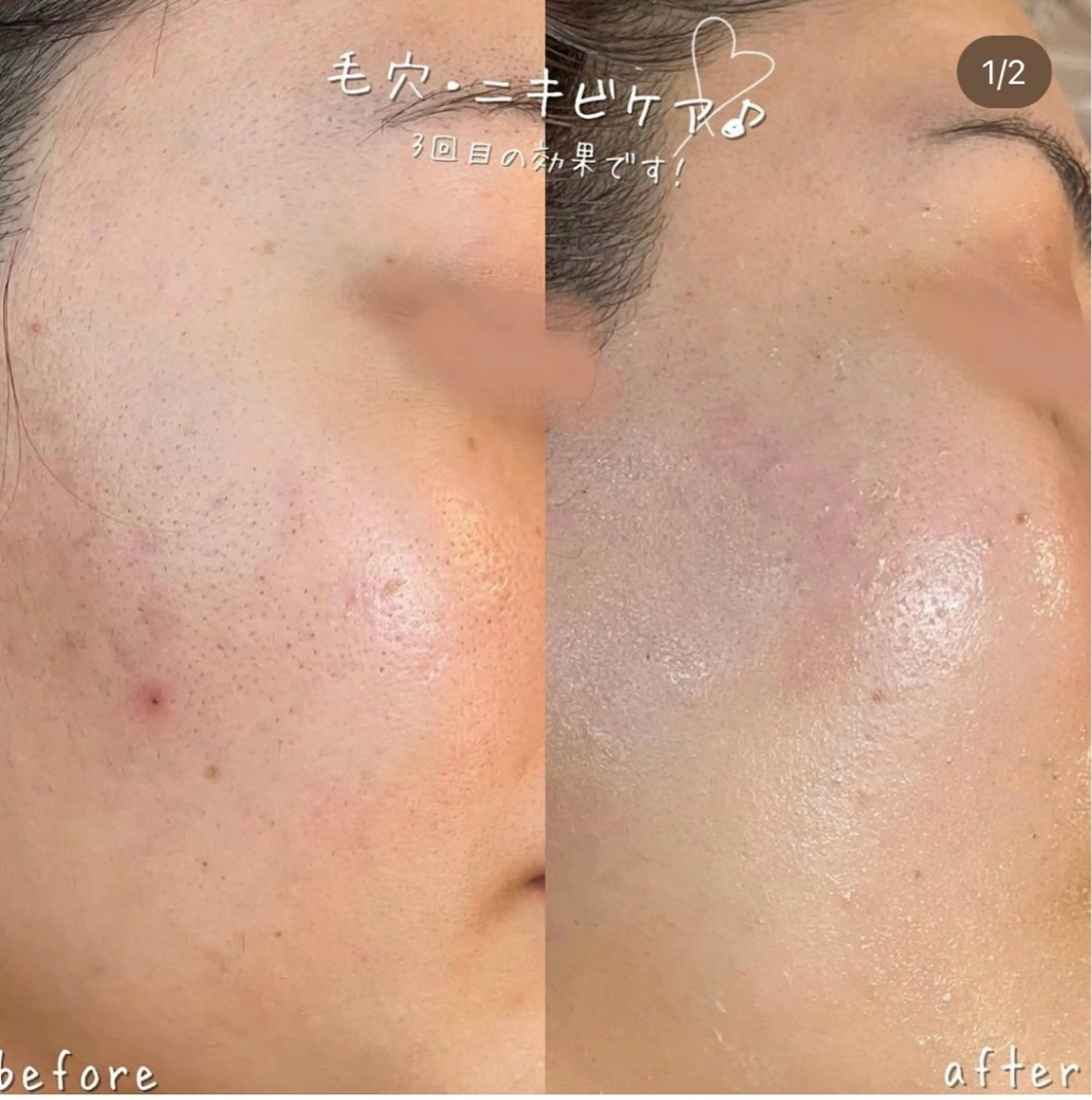 【ハーブピーリング/毛穴洗浄】NA skin 川崎店〜ニキビ・毛穴専門店〜所属・NAskin川崎 皆川のエステ・リラクイメージ