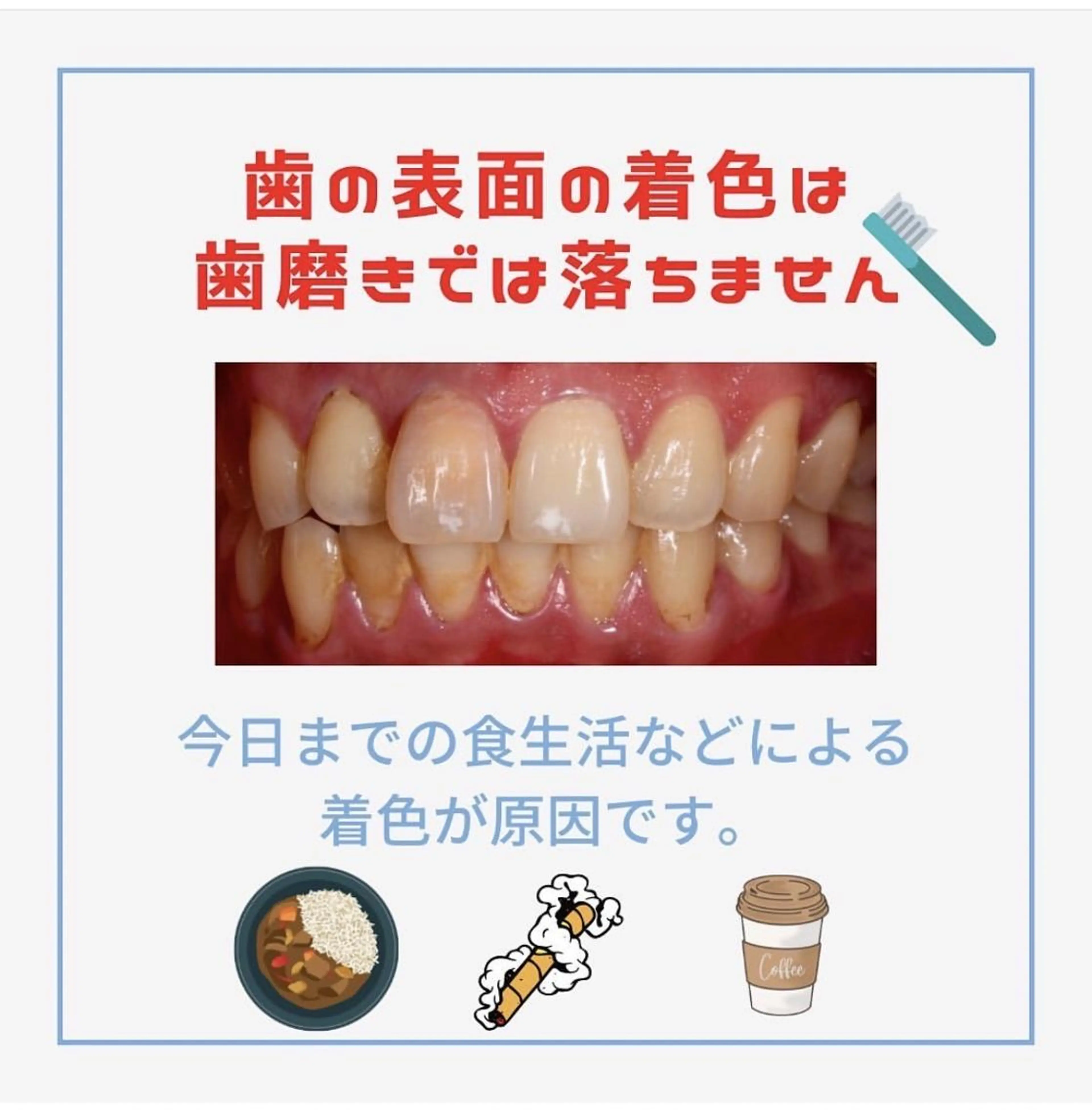 【チラシお持ちの方限定】チラシをお持ちの方はこちらから◎/ホワイトニングの写真